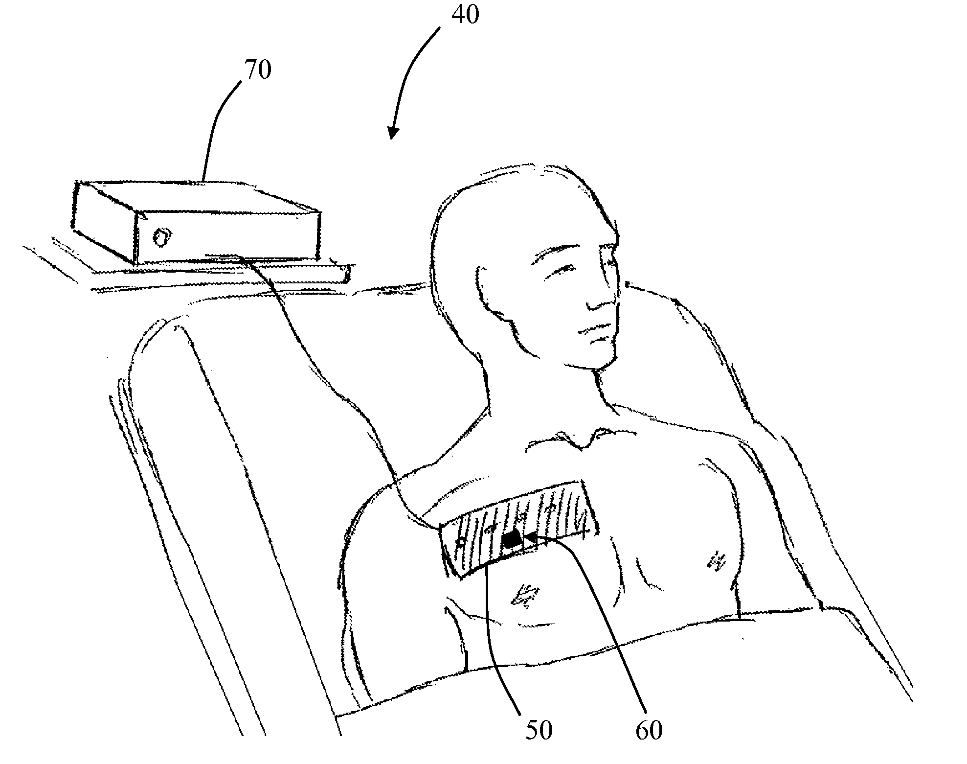 Automatic continuous a-mode ultrasound monitor for pneumothorax