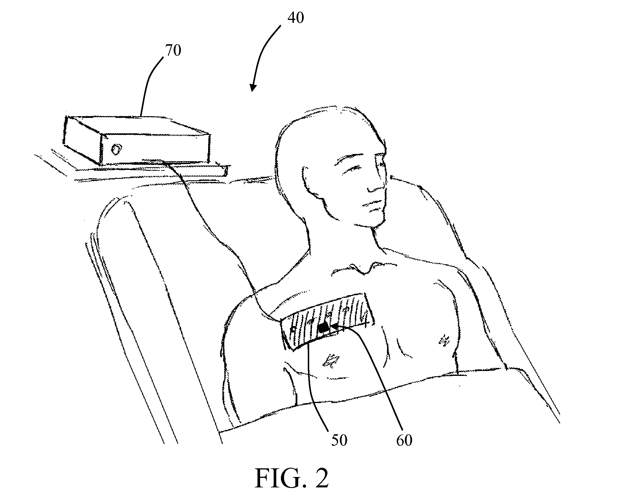 Automatic continuous a-mode ultrasound monitor for pneumothorax