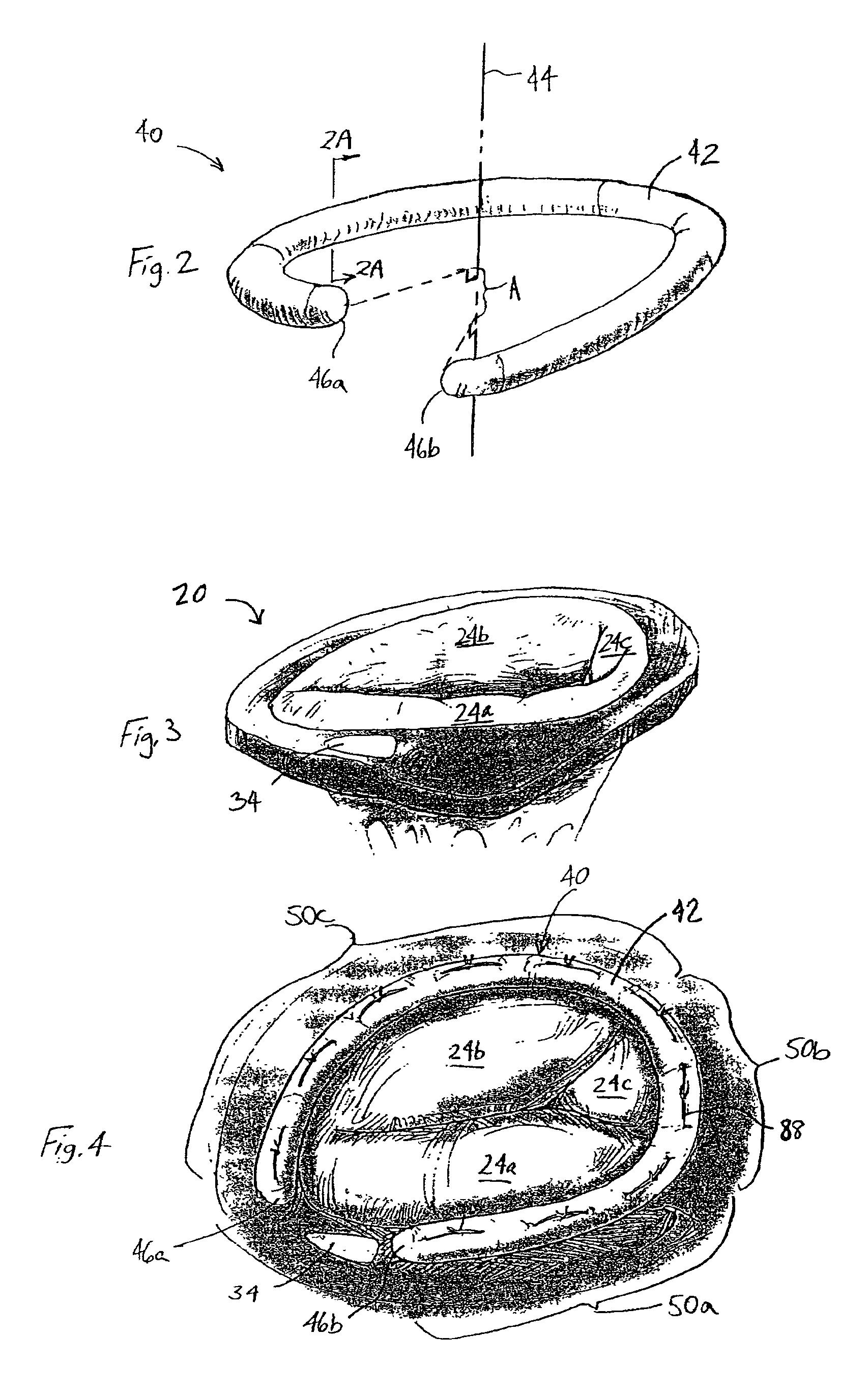 Three-dimensional annuloplasty ring and template