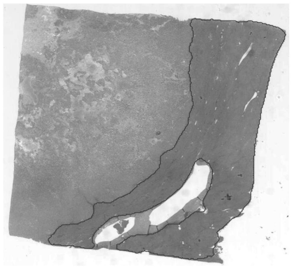 Cancer WSI segmentation method based on local classification neural network