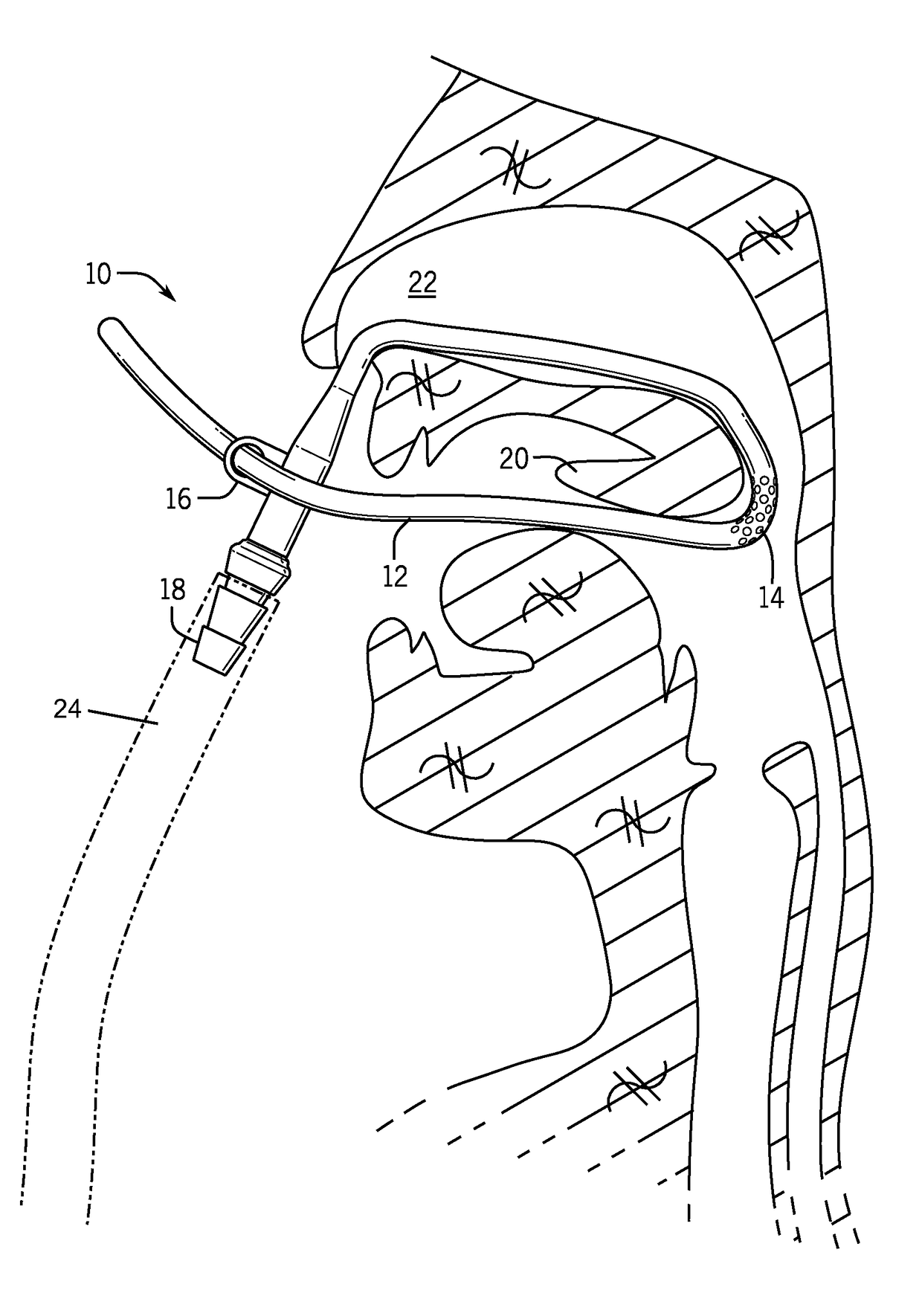 Retractor suction catheter