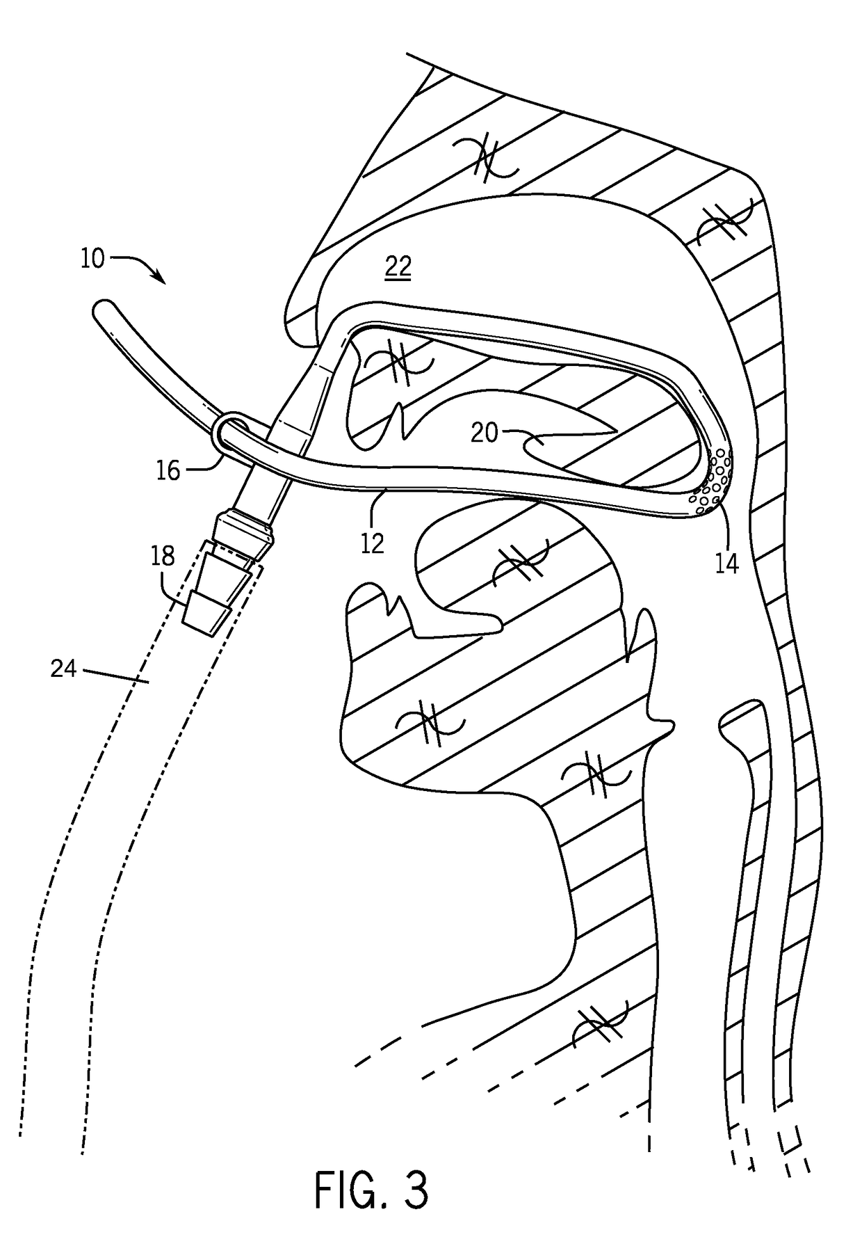 Retractor suction catheter