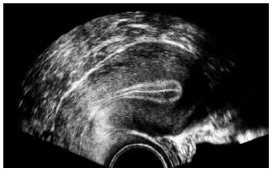 Endometrium thickness automatic measurement method and system based on wavelet transform