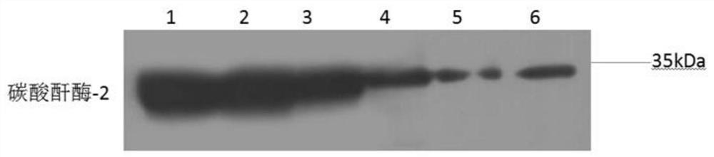 Application of carbonic anhydrase-2 as a detection marker in the diagnosis of kidney stones