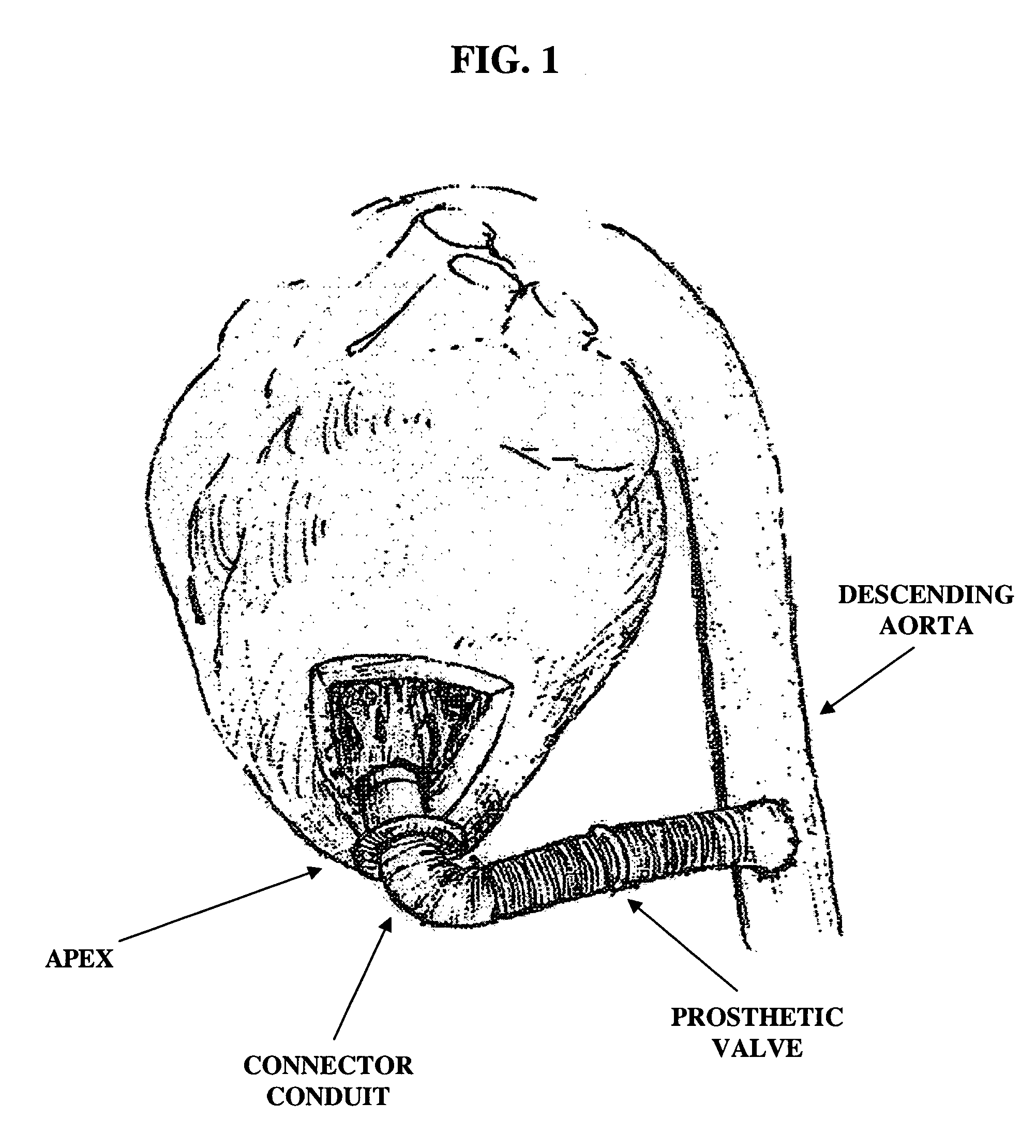 Apparatus and method for connecting a conduit to a hollow organ