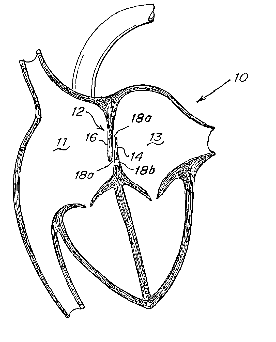 Implant-catheter attachment mechanism using snare and method of use