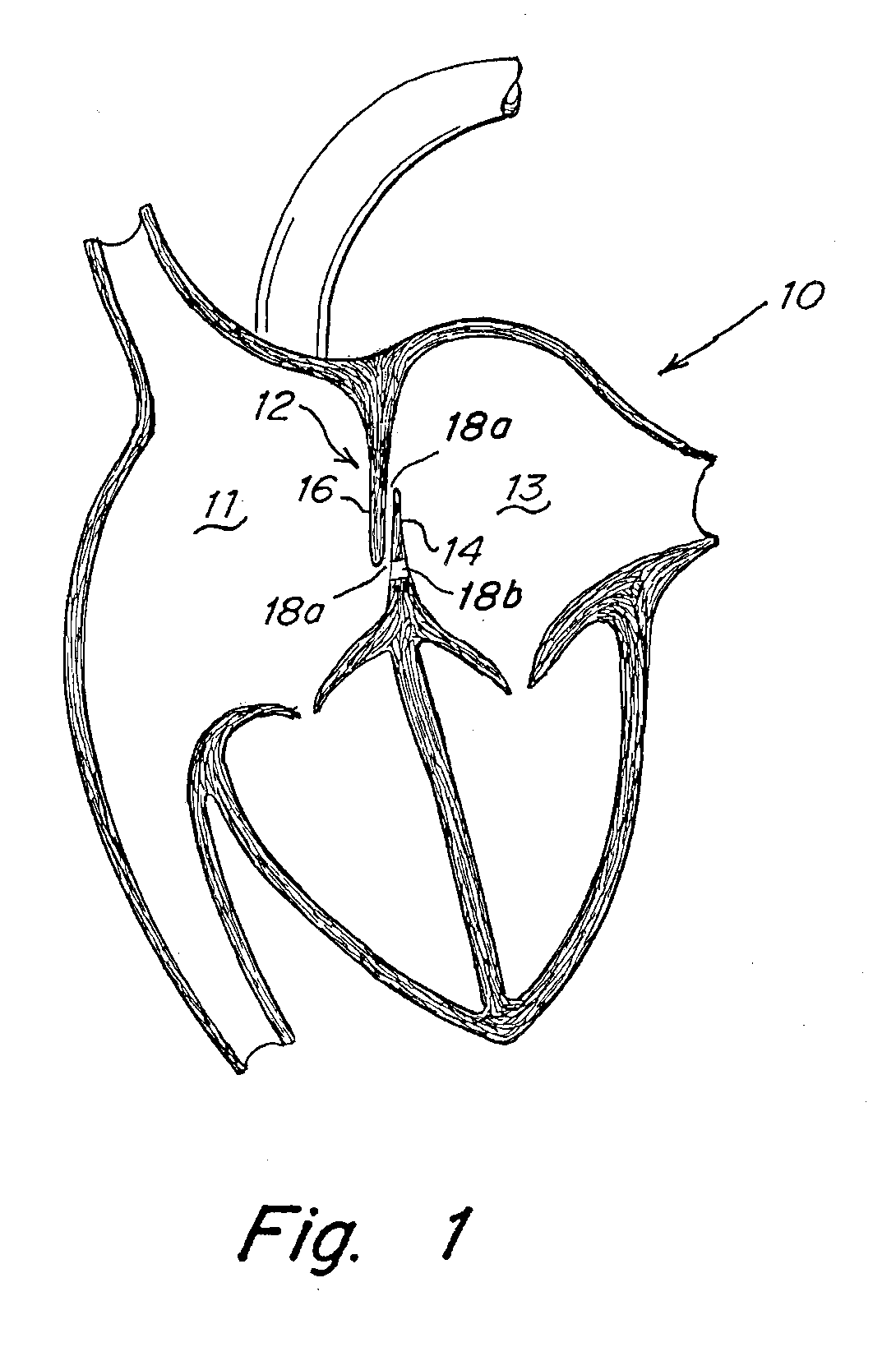 Implant-catheter attachment mechanism using snare and method of use