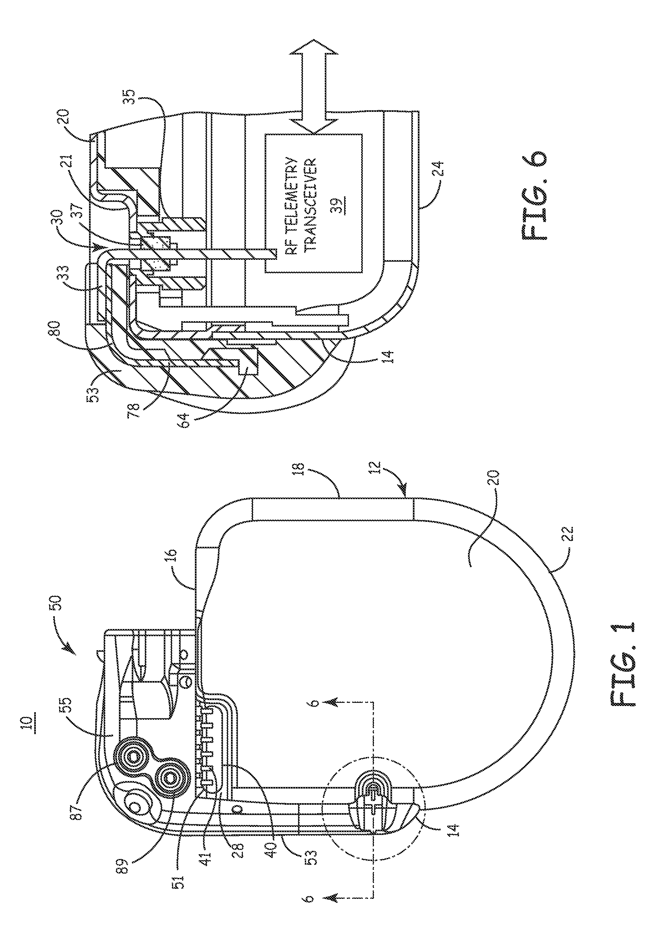 Telemetry antenna for an implantable medical device