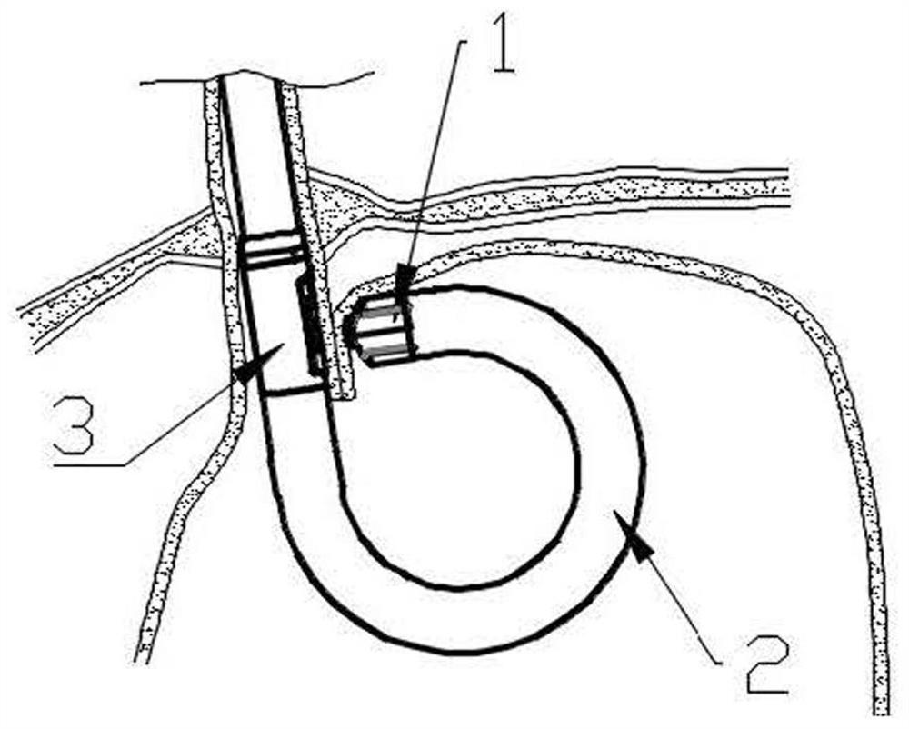 Endoscope device and system for treating gastroesophageal reflux disease and control method of endoscope device and system