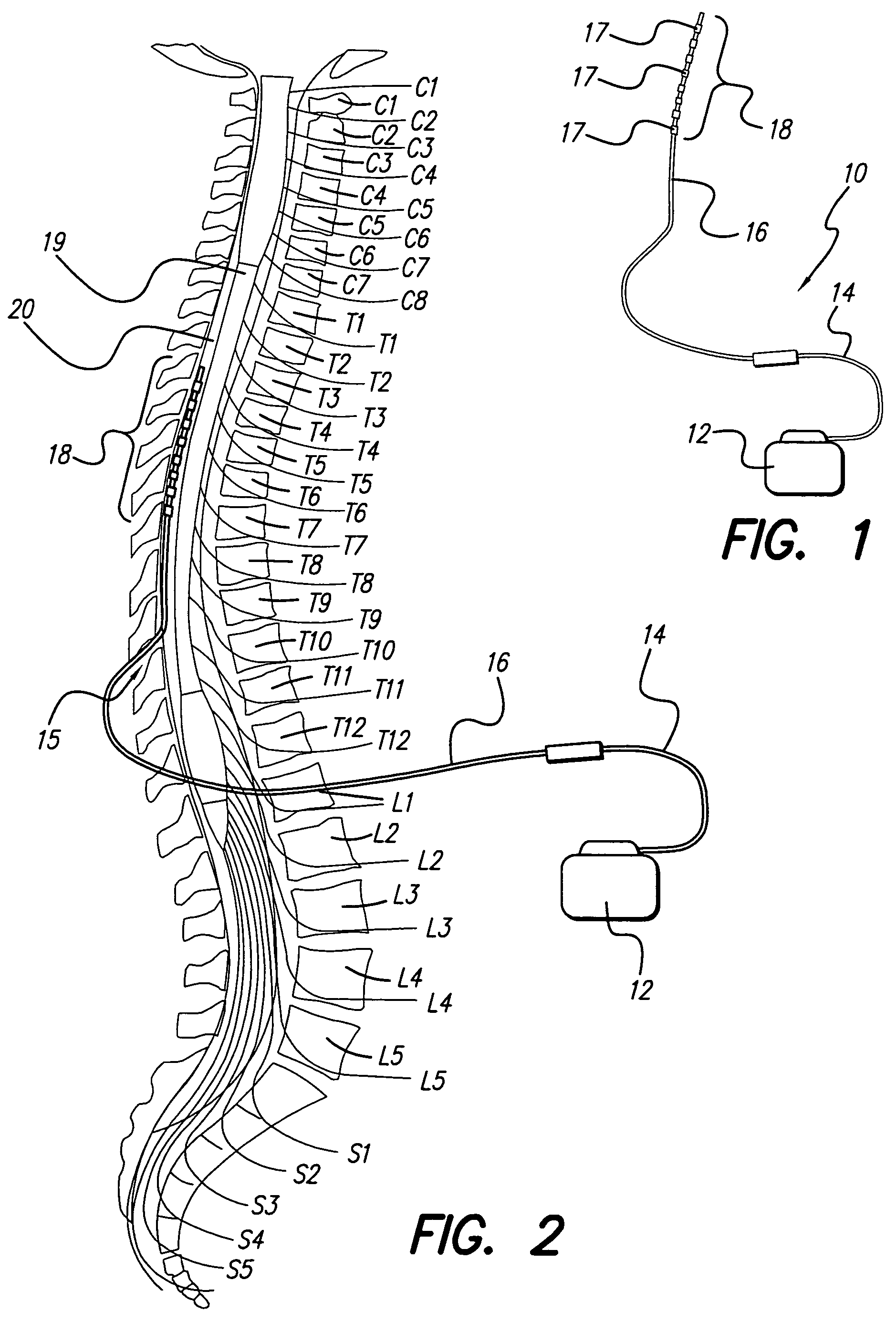 Method for determining stimulation parameters