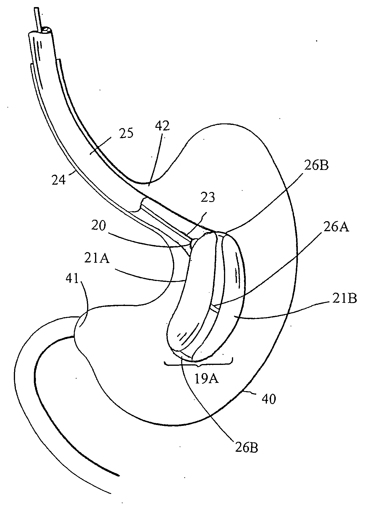 Intragastric space filler