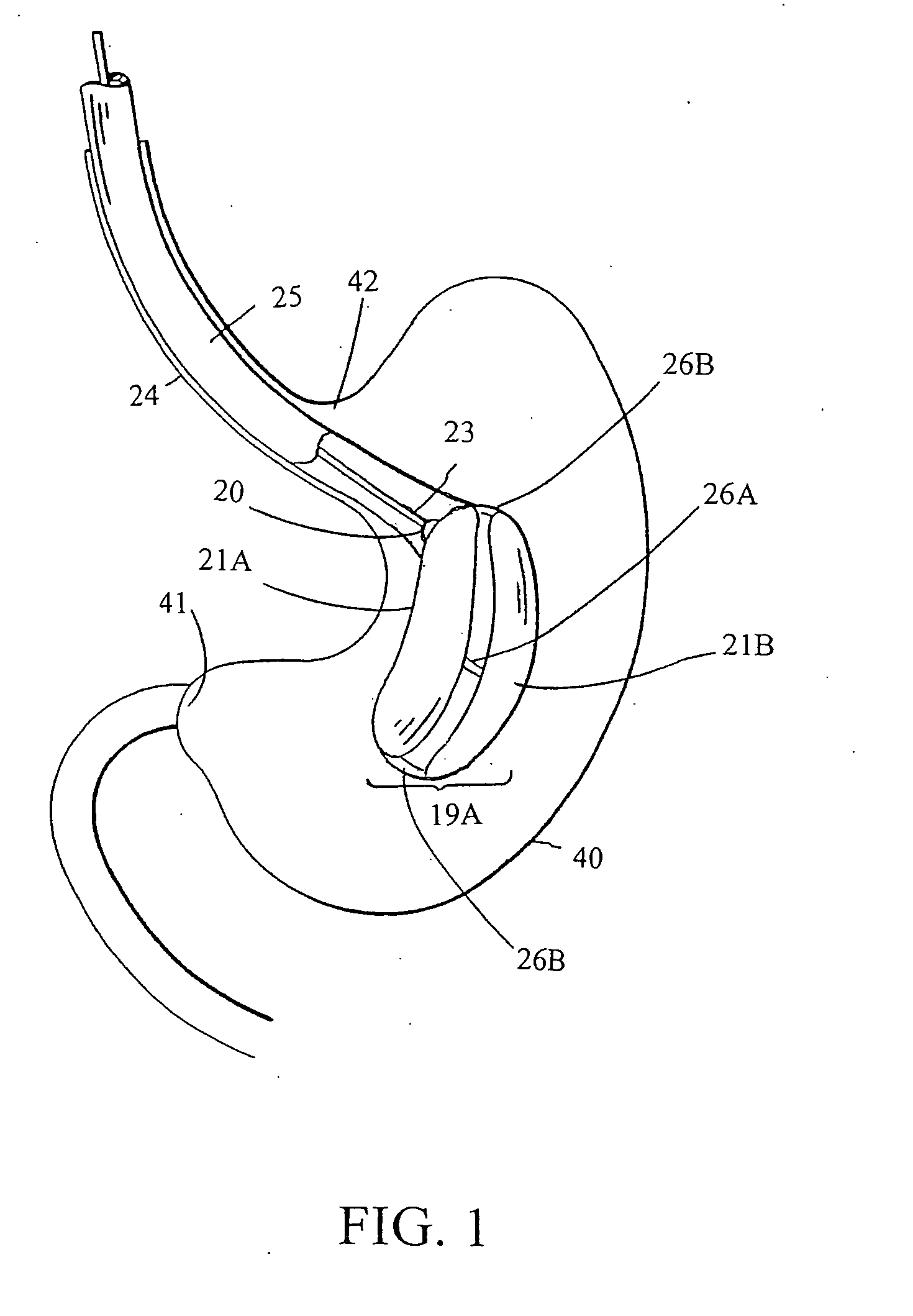 Intragastric space filler