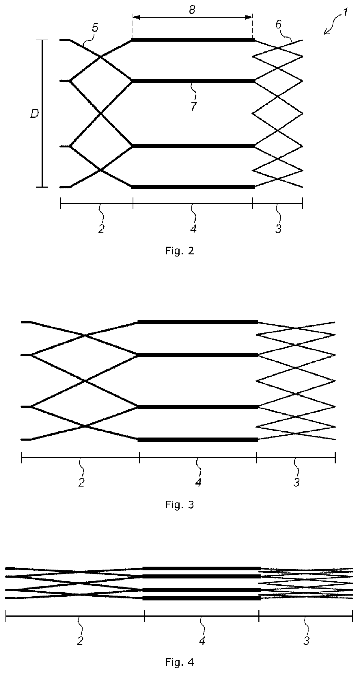 Implant stent device