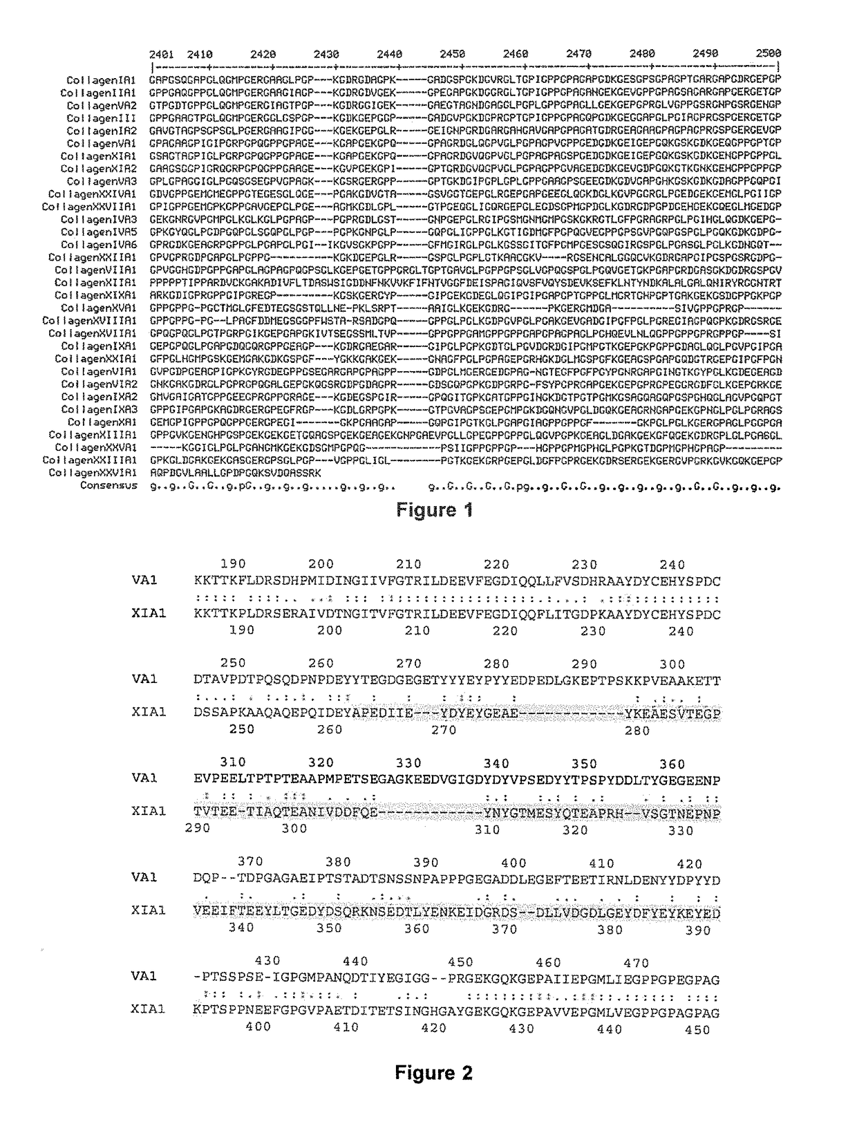 Methods and products for in vitro diagnosis, in vitro prognosis and the development of drugs against invasive carcinomas