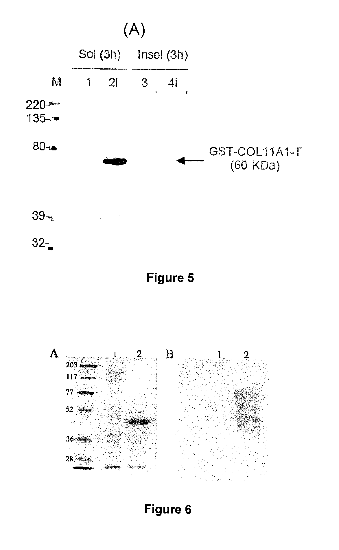 Methods and products for in vitro diagnosis, in vitro prognosis and the development of drugs against invasive carcinomas