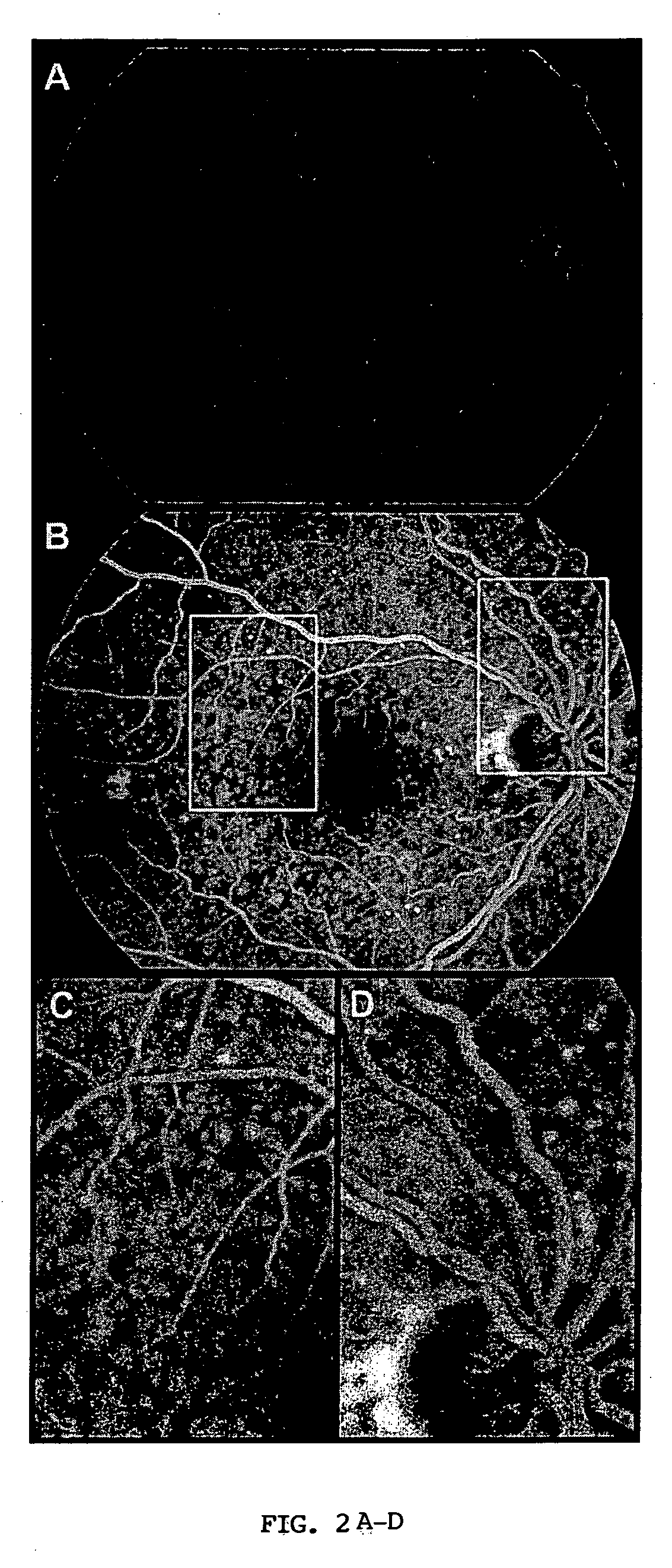 Alterations of fibulin genes in macular degeneration