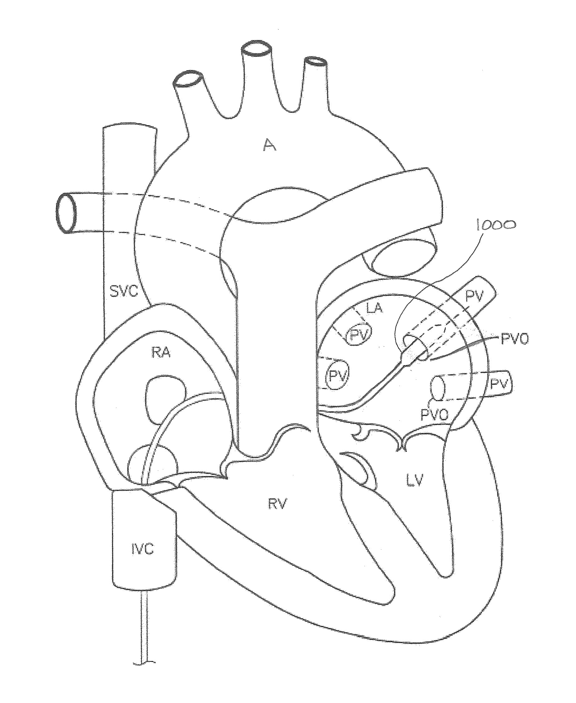 Devices and methods for denervation of the nerves surrounding the pulmonary veins for treatment of atrial fibrillation