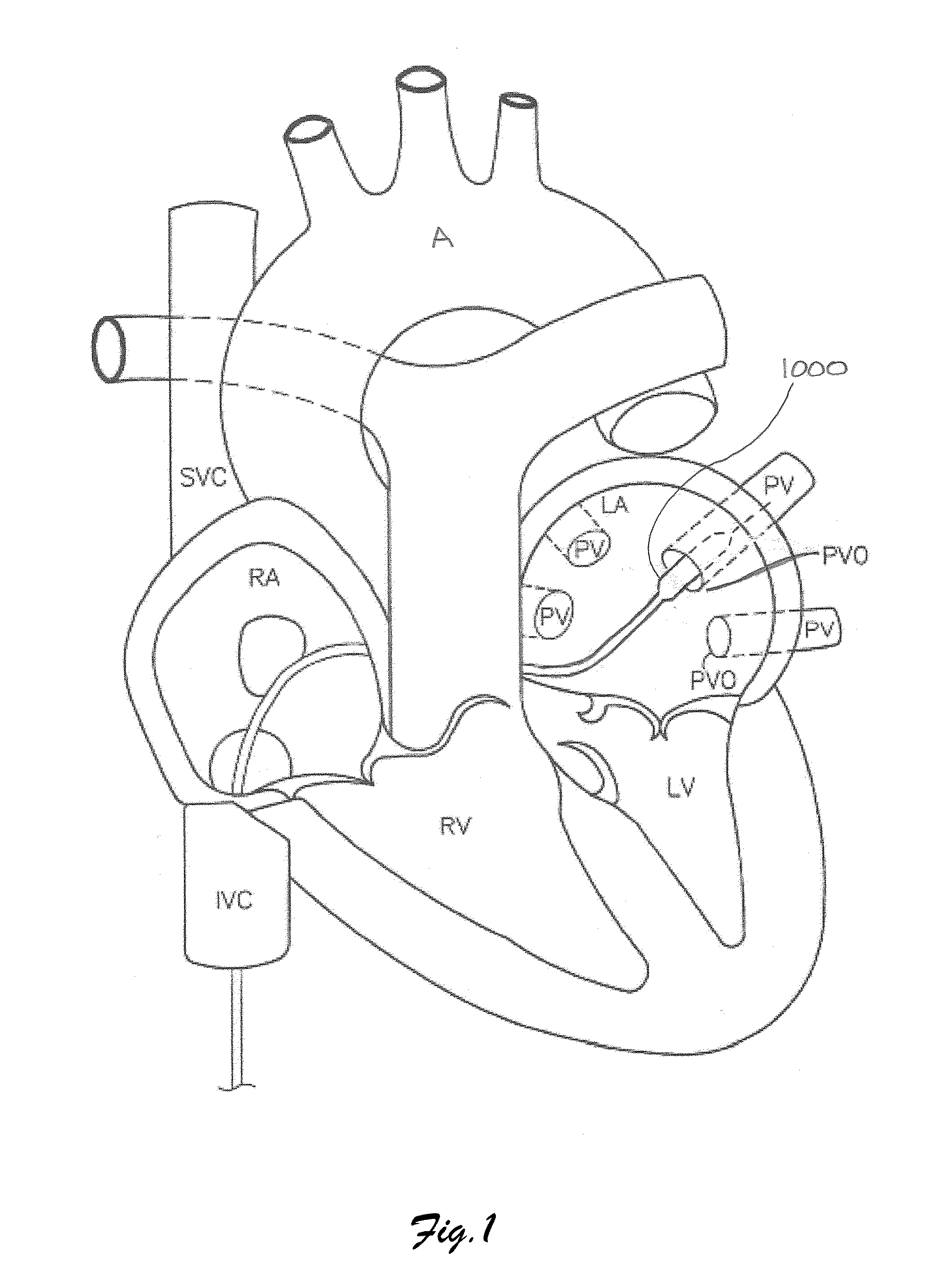 Devices and methods for denervation of the nerves surrounding the pulmonary veins for treatment of atrial fibrillation