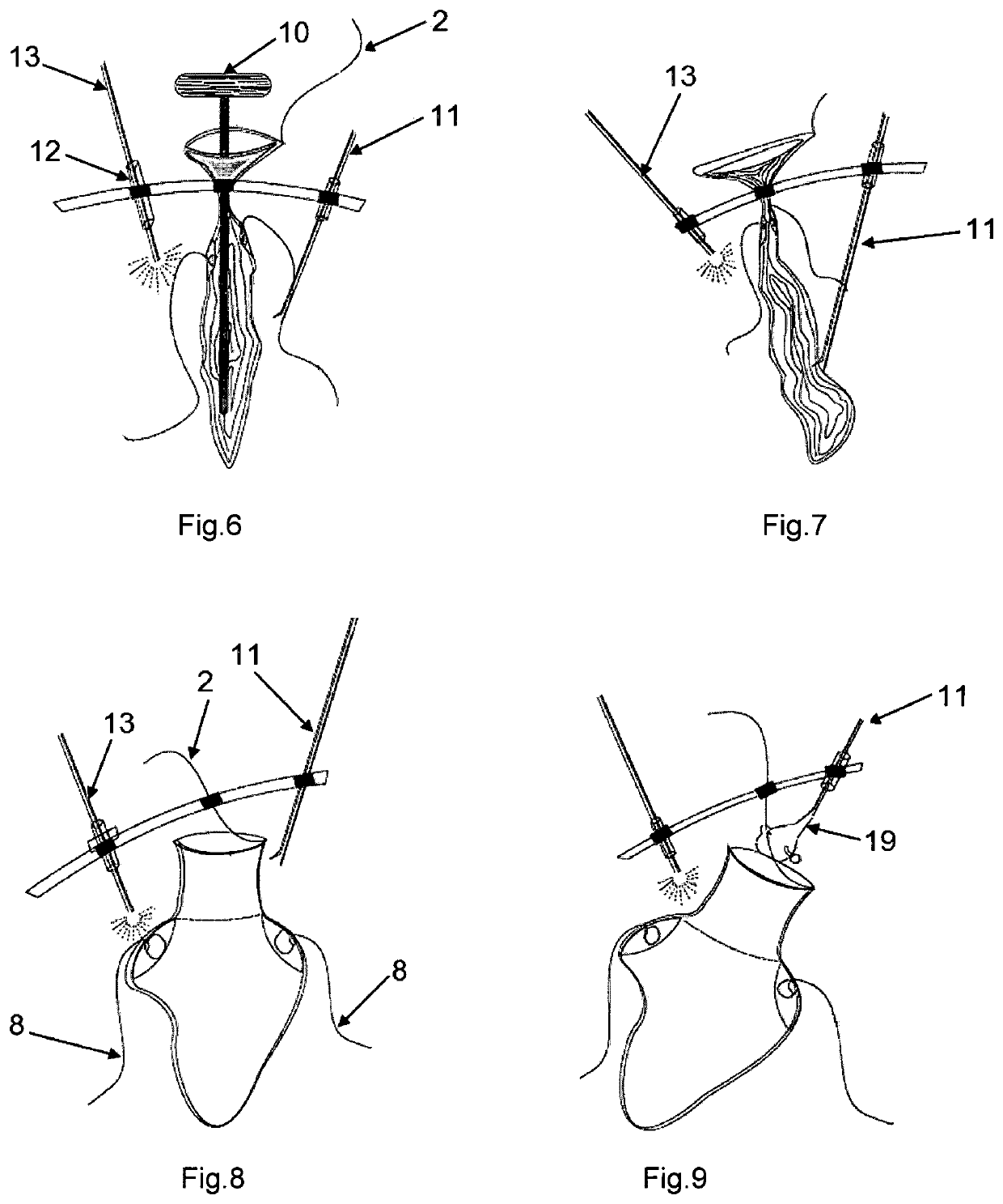 Safety isolation bags for intra abdominal, endoscopic procedures, power morcellation and vaginal morcellation