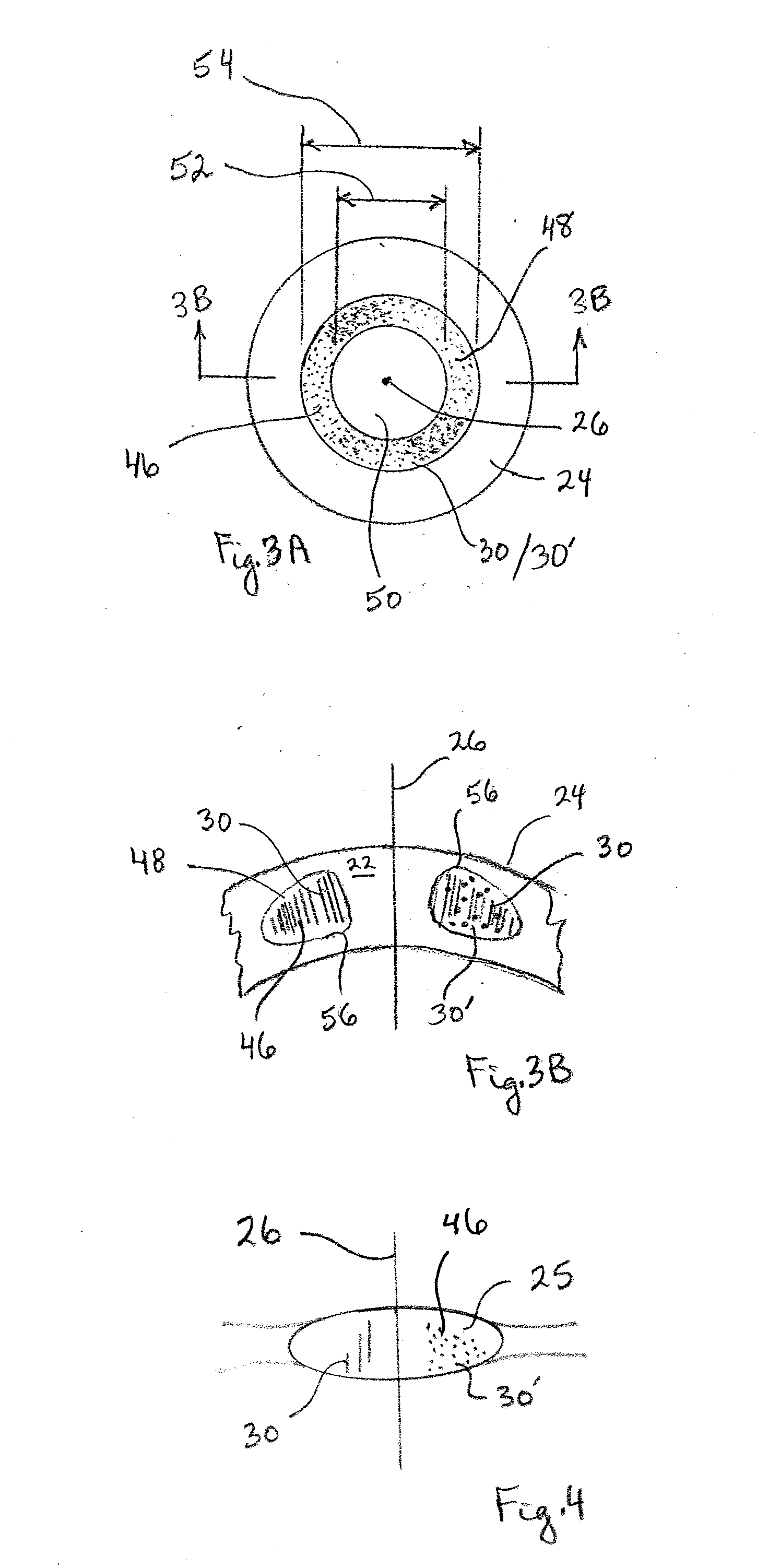 System and Method for Minimizing the Side Effects of Refractive Corrections Using Line or Dot Cuts for Incisions