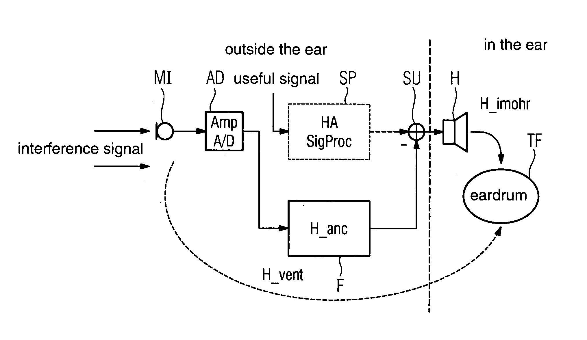 Hearing device with interference sound suppression and corresponding method