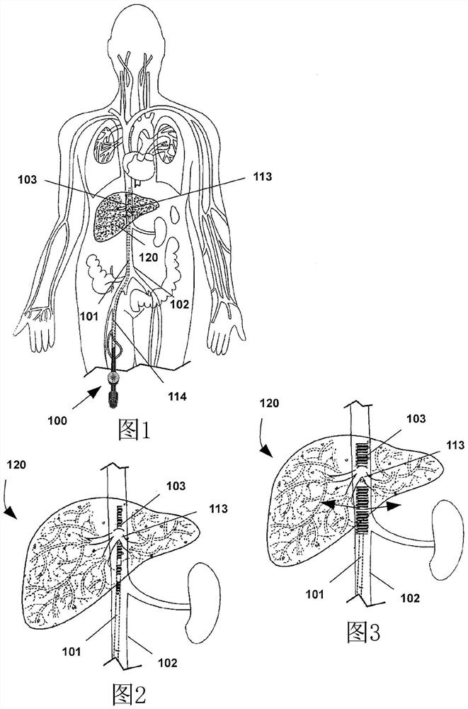 Endoprosthesis for a total vascular exclusion of the liver