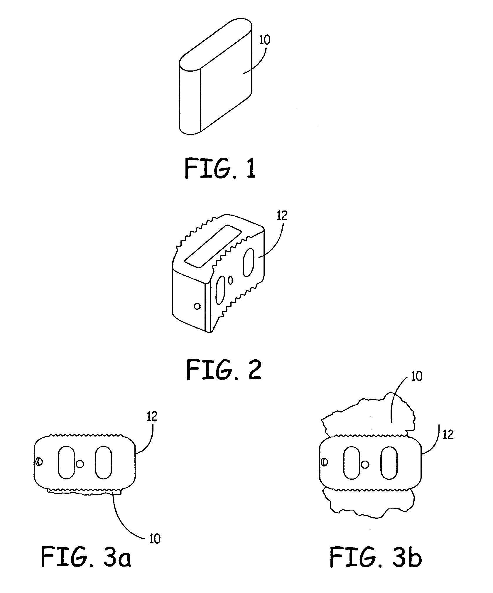 Expandable osteoimplant