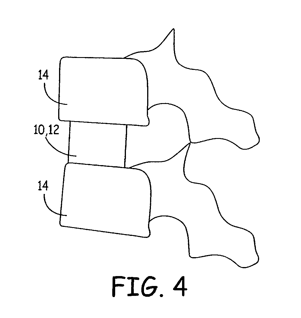 Expandable osteoimplant