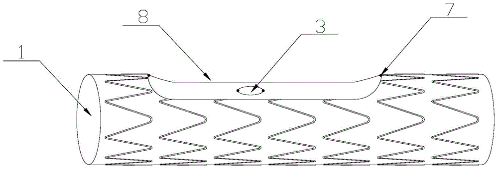 a stent graft