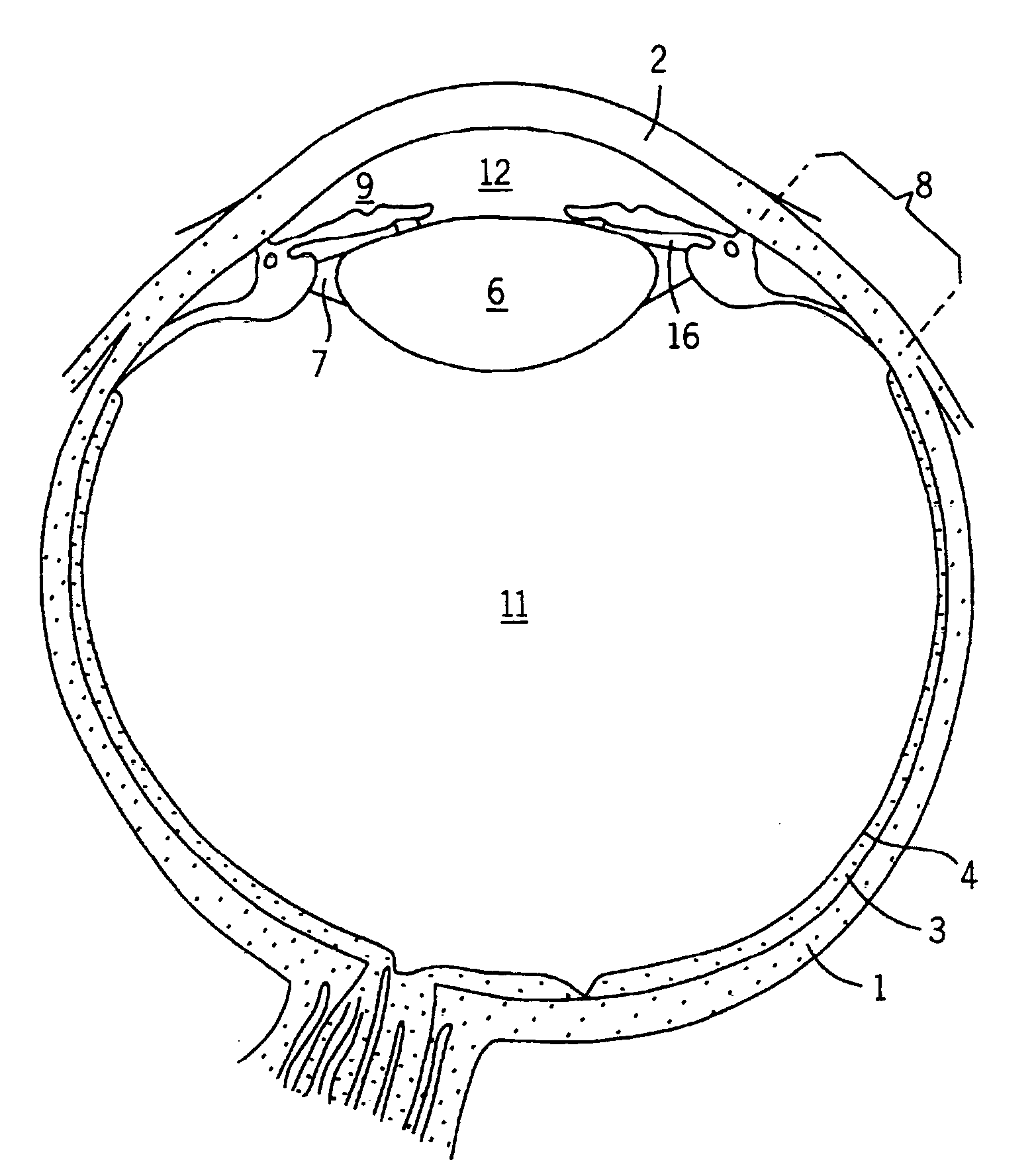 Implantable pump apparatuses