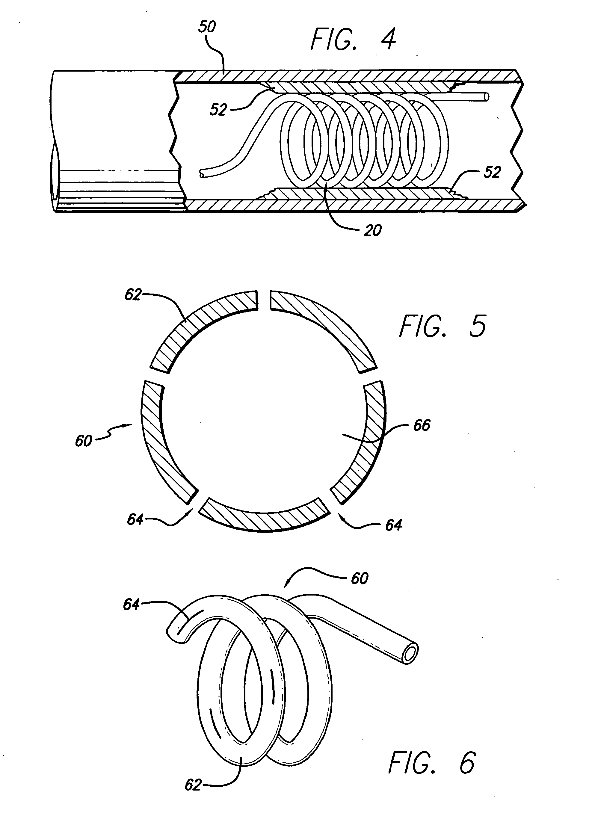 Method of recapturing a stent