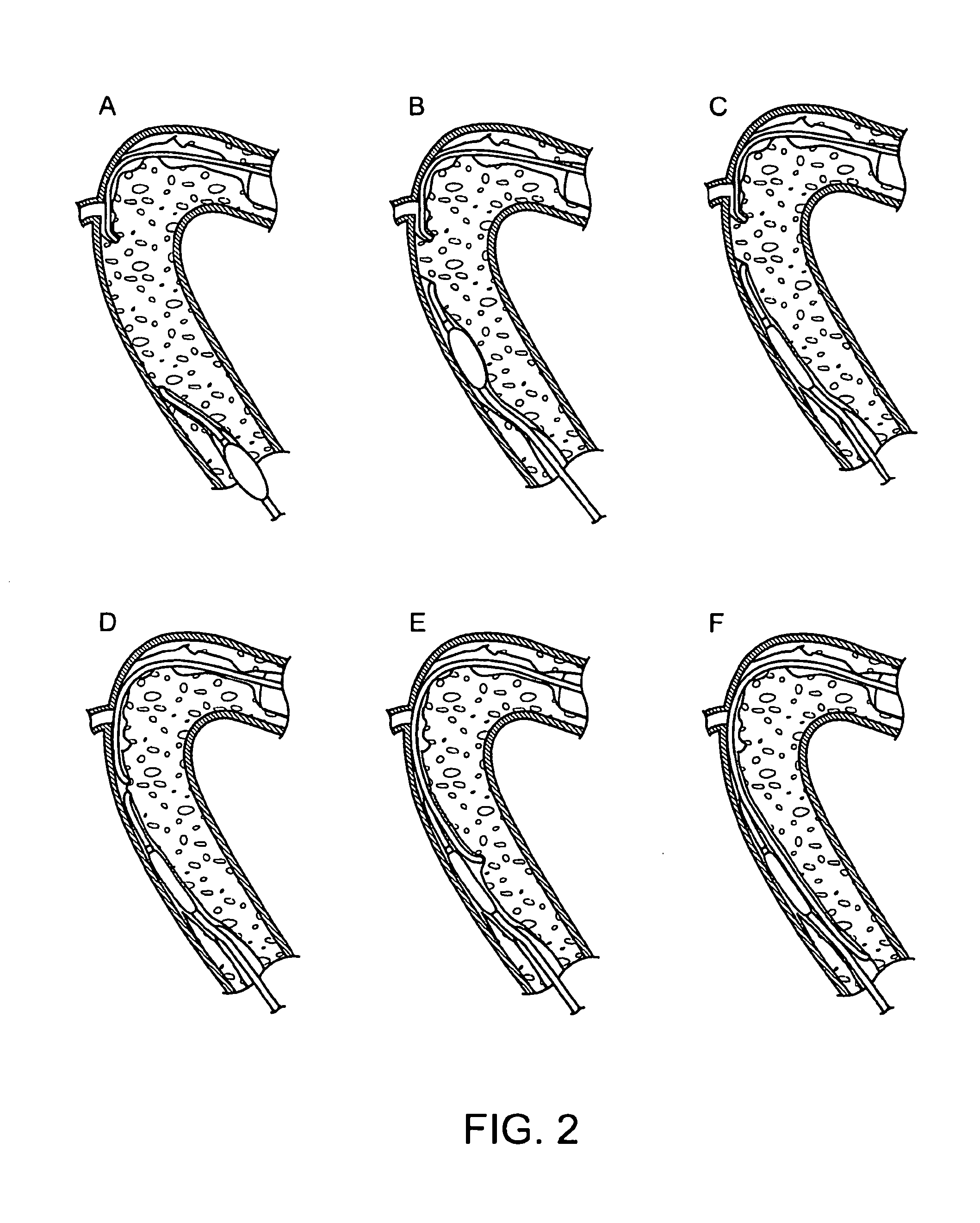 Recanalizing occluded vessels using controlled antegrade and retrograde tracking