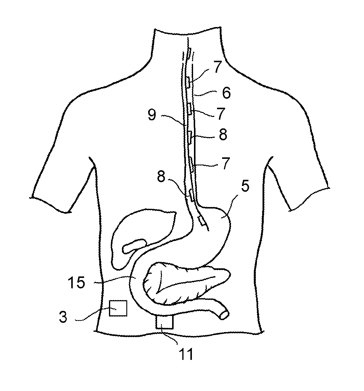 Devices and methods for the treatment of metabolic disorders