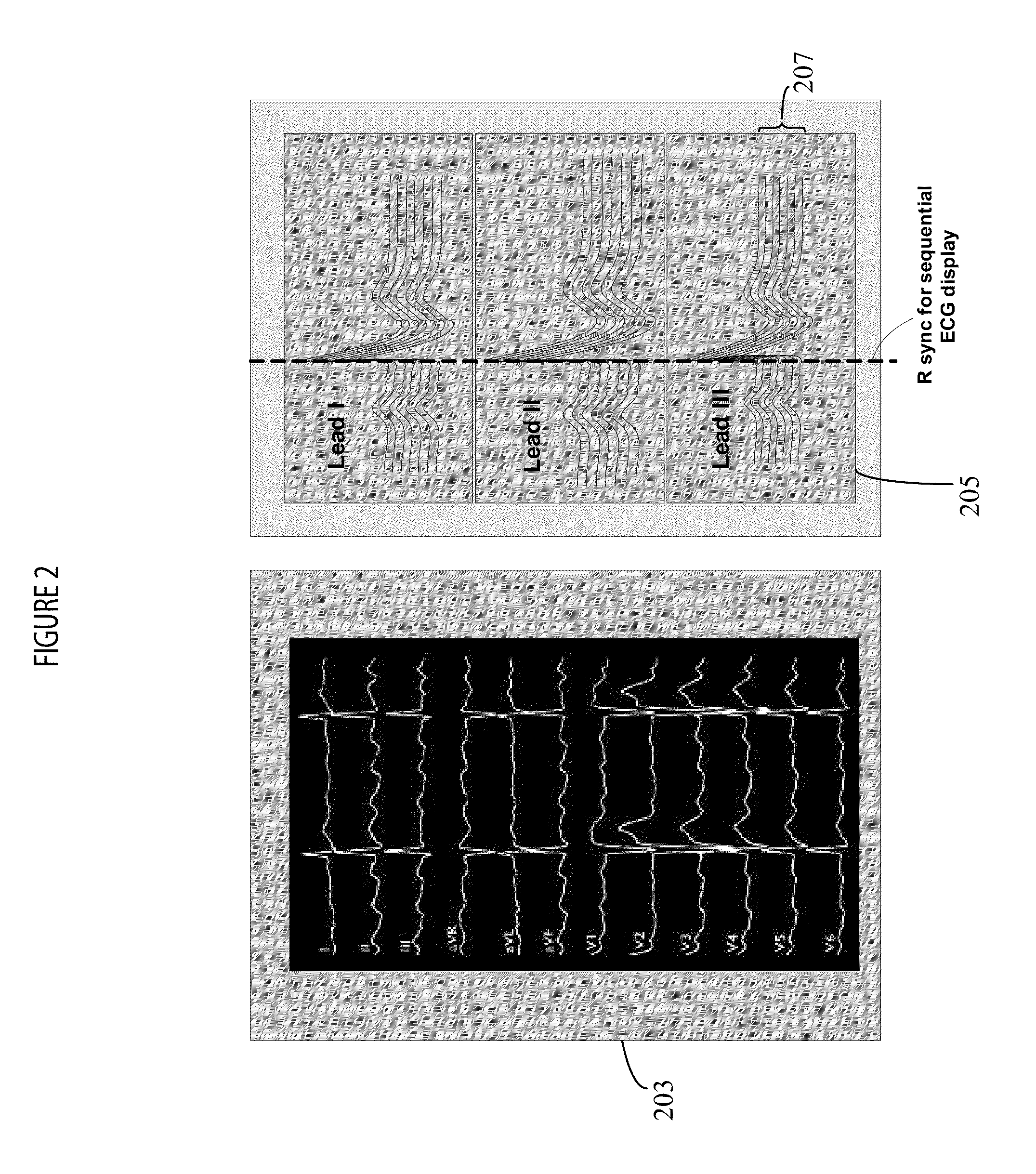 System for monitoring and diagnosis of cardiac electrogram signals using multi-dimensional analysis