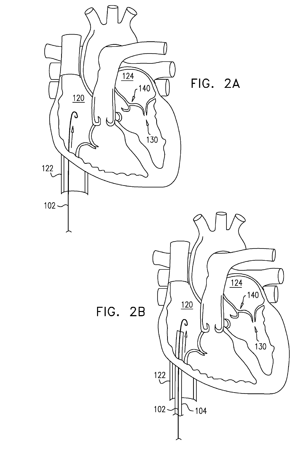 Closed band for percutaneous annuloplasty