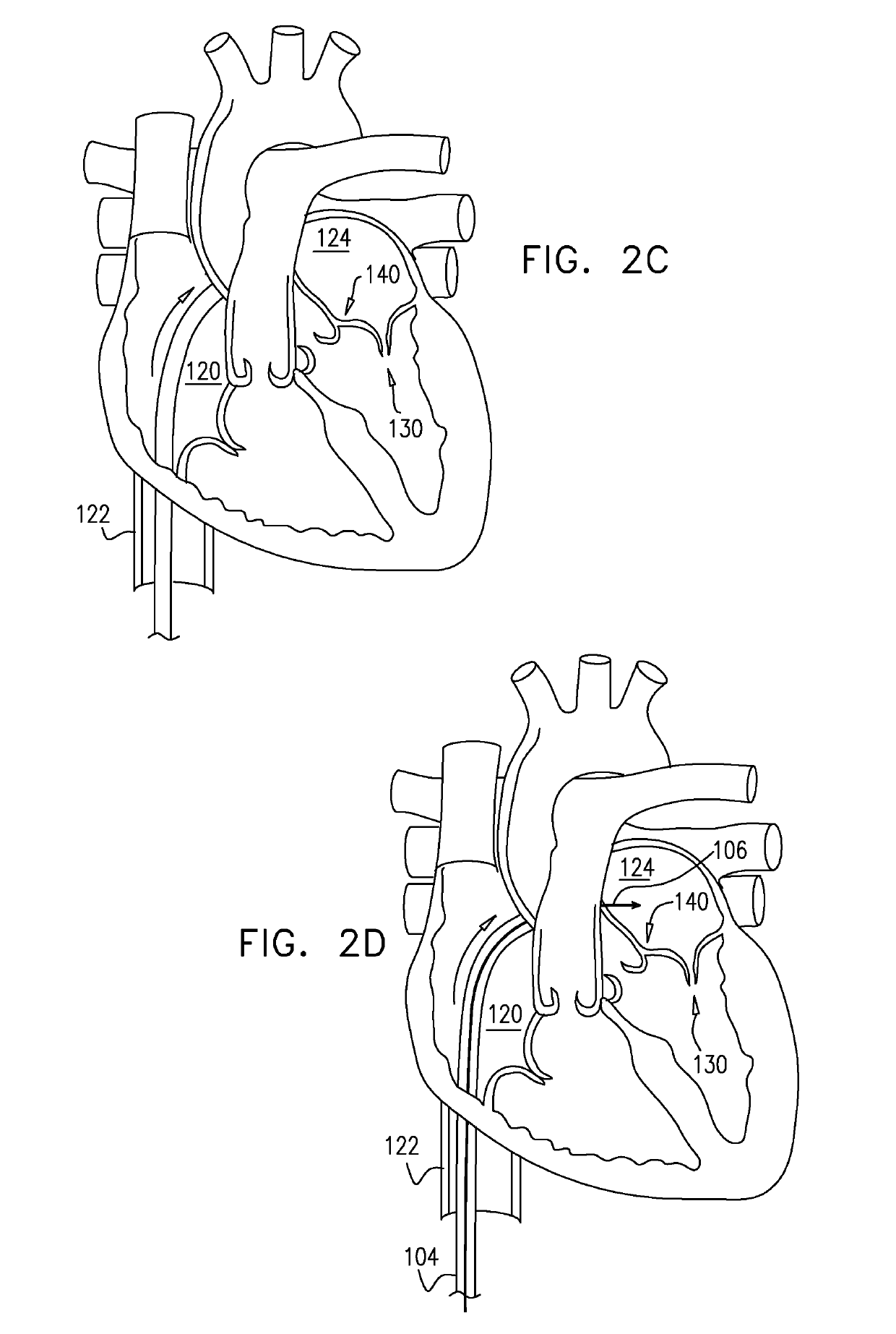 Closed band for percutaneous annuloplasty