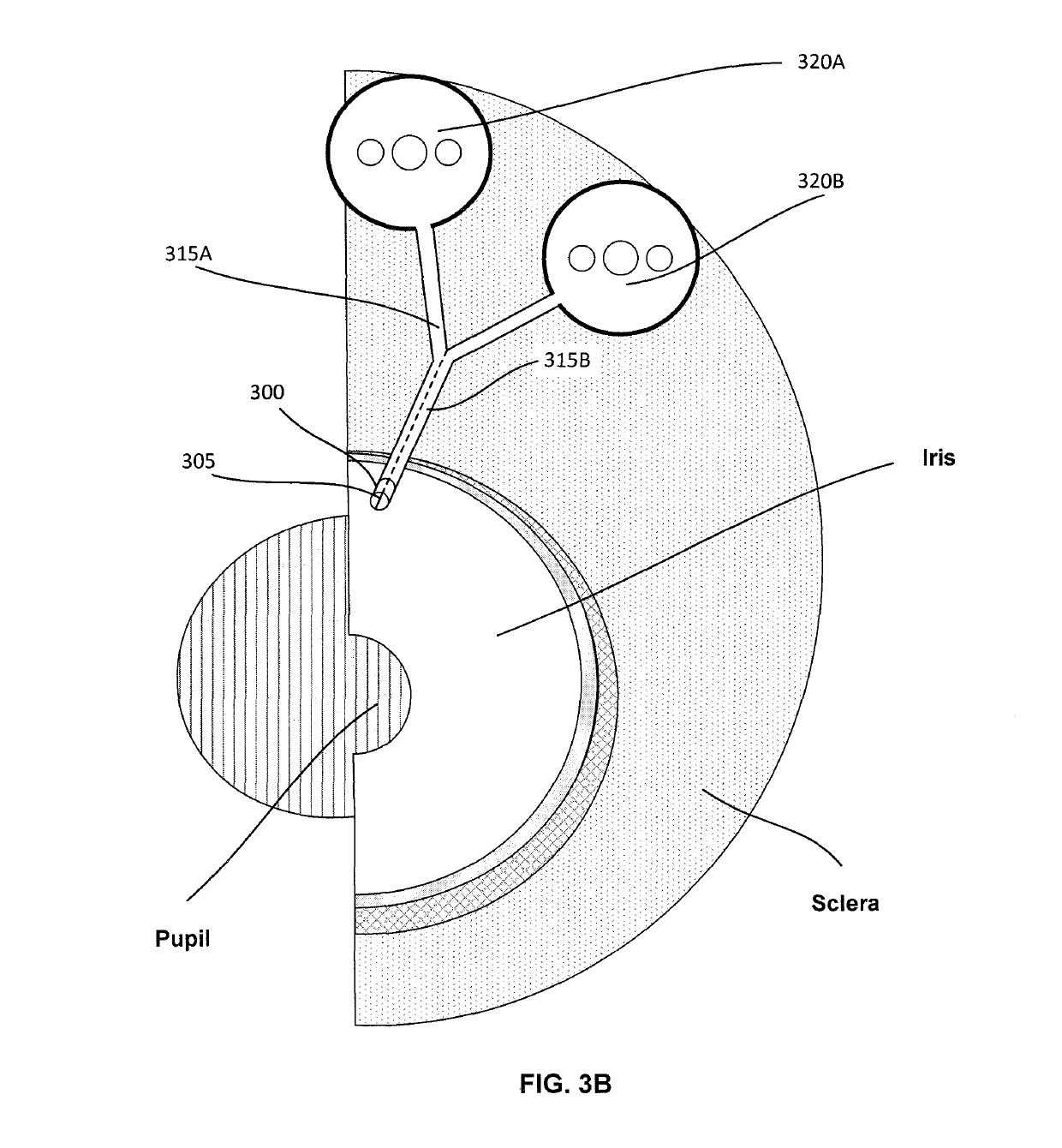 Ocular filtration devices, systems and methods