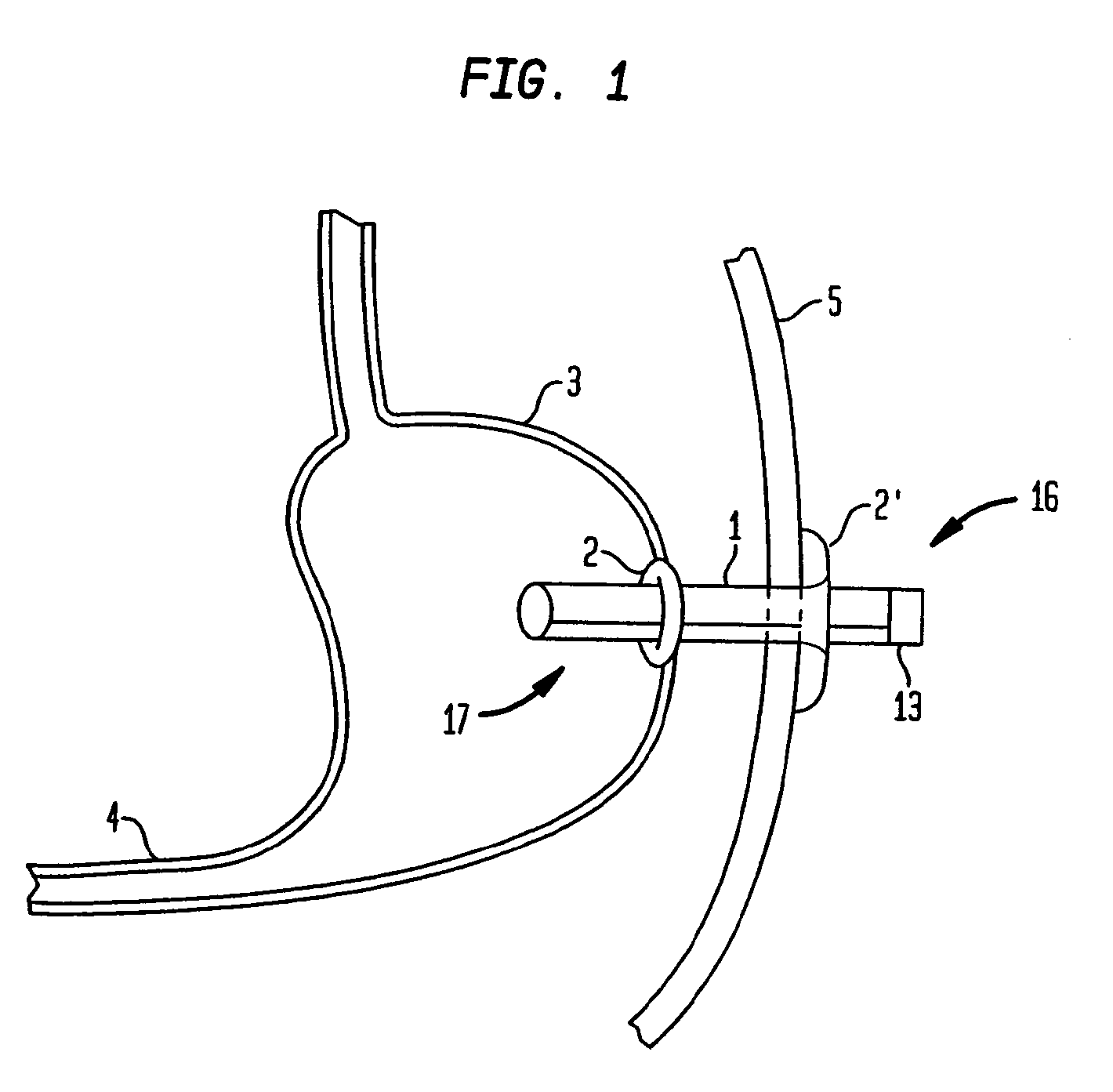 Method for treating obesity by extracting food