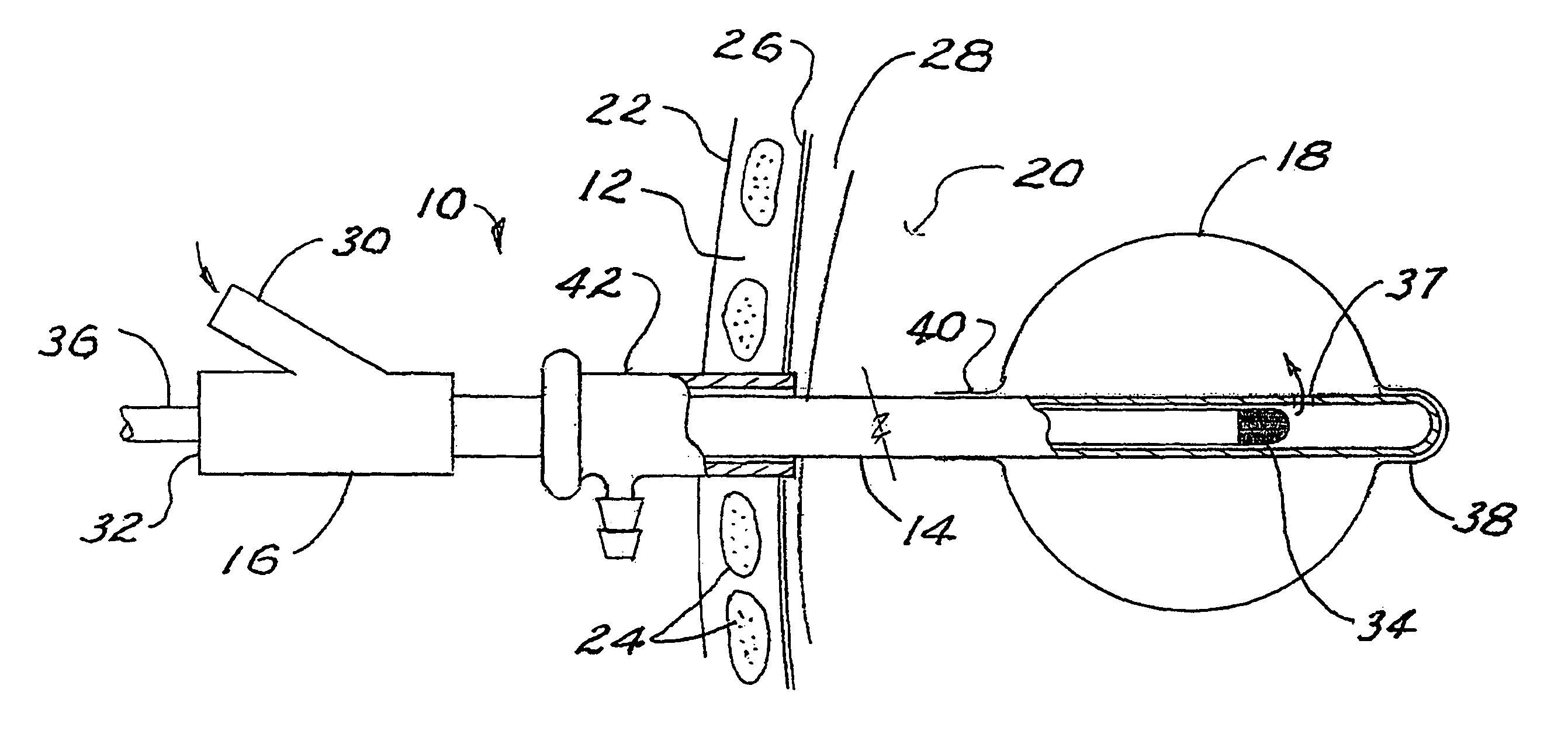 Brachytherapy apparatus and method for use with minimally invasive surgeries of the lung