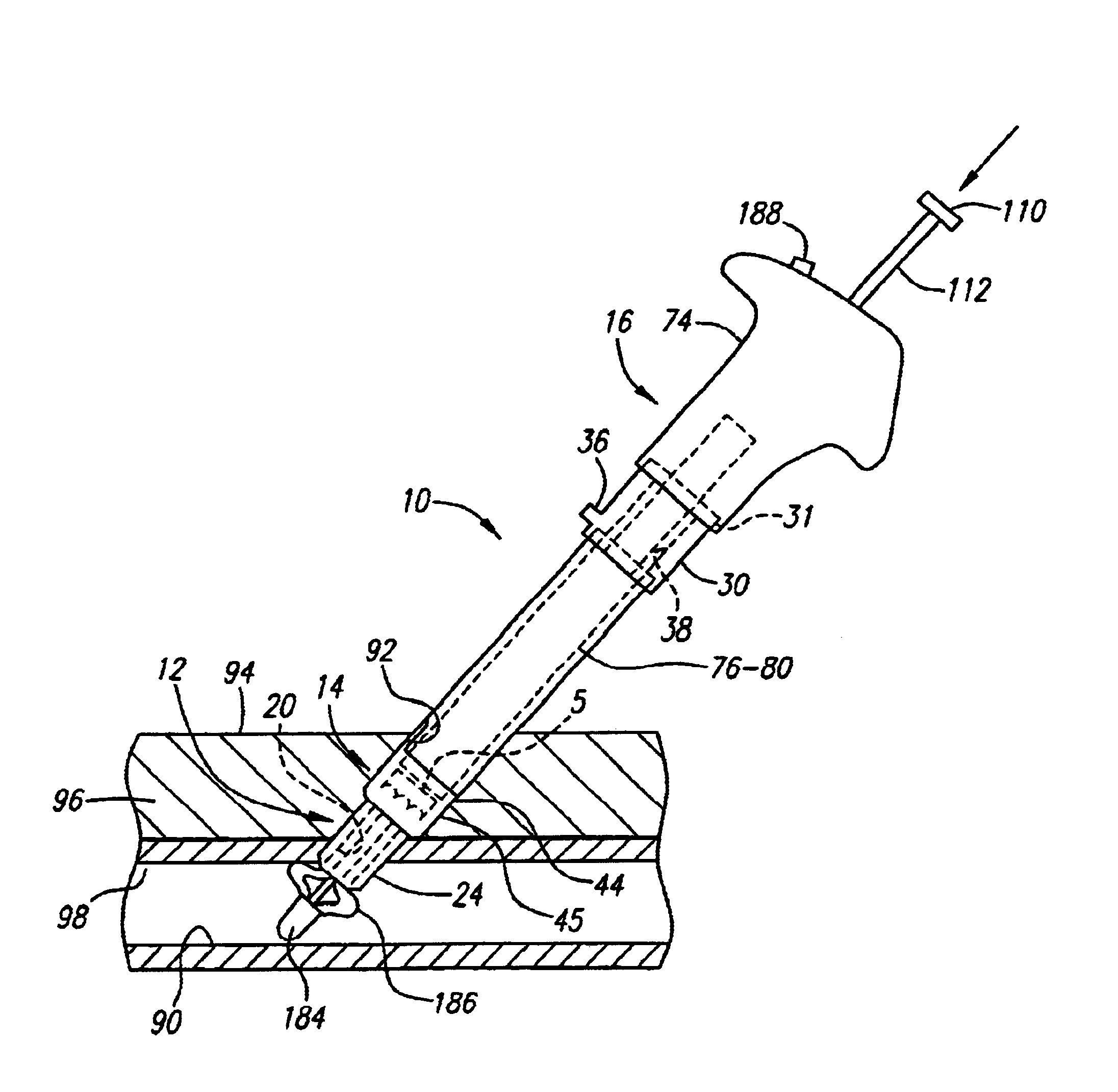 Apparatus and methods for delivering a closure device