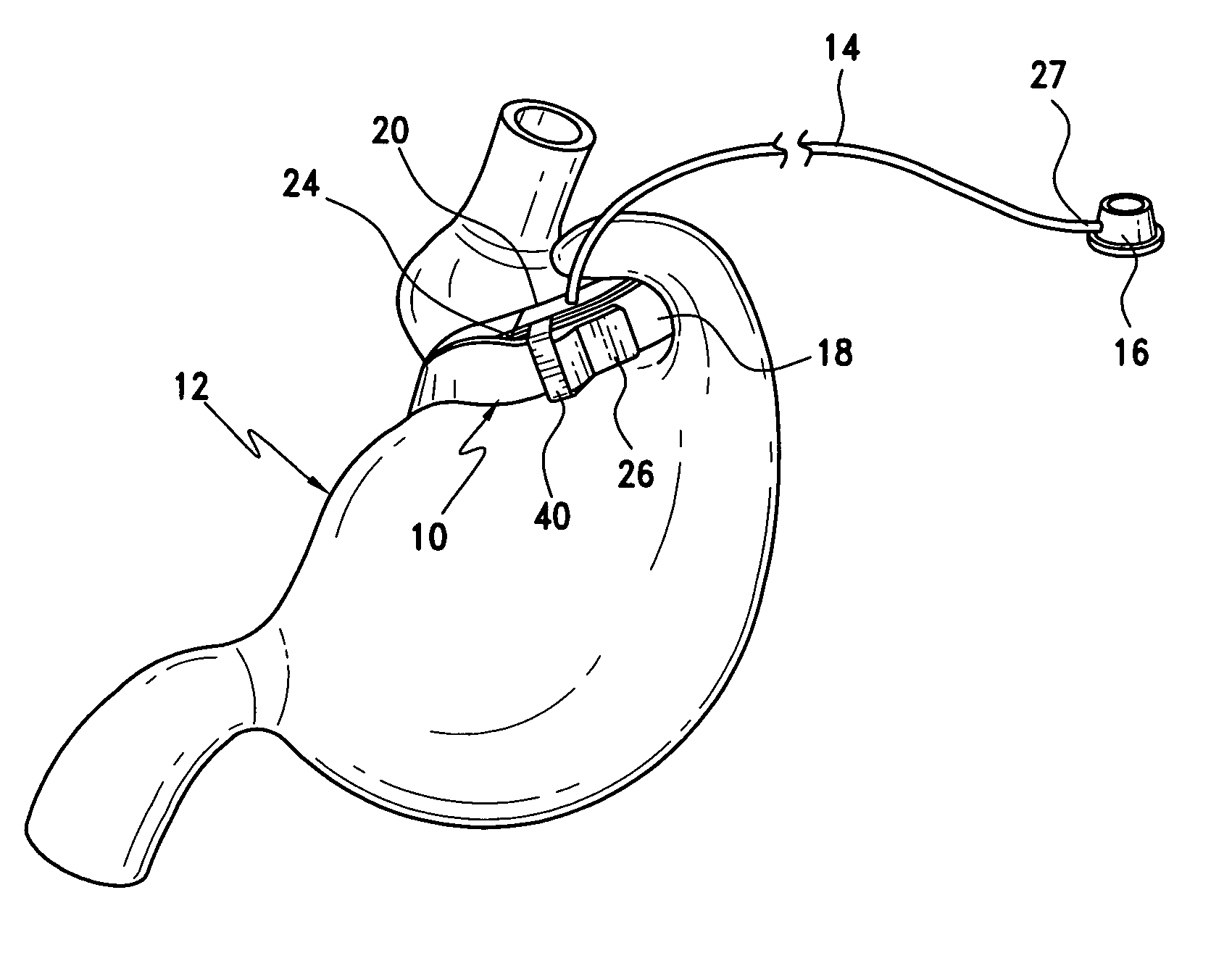 Gastric band with mating end profiles