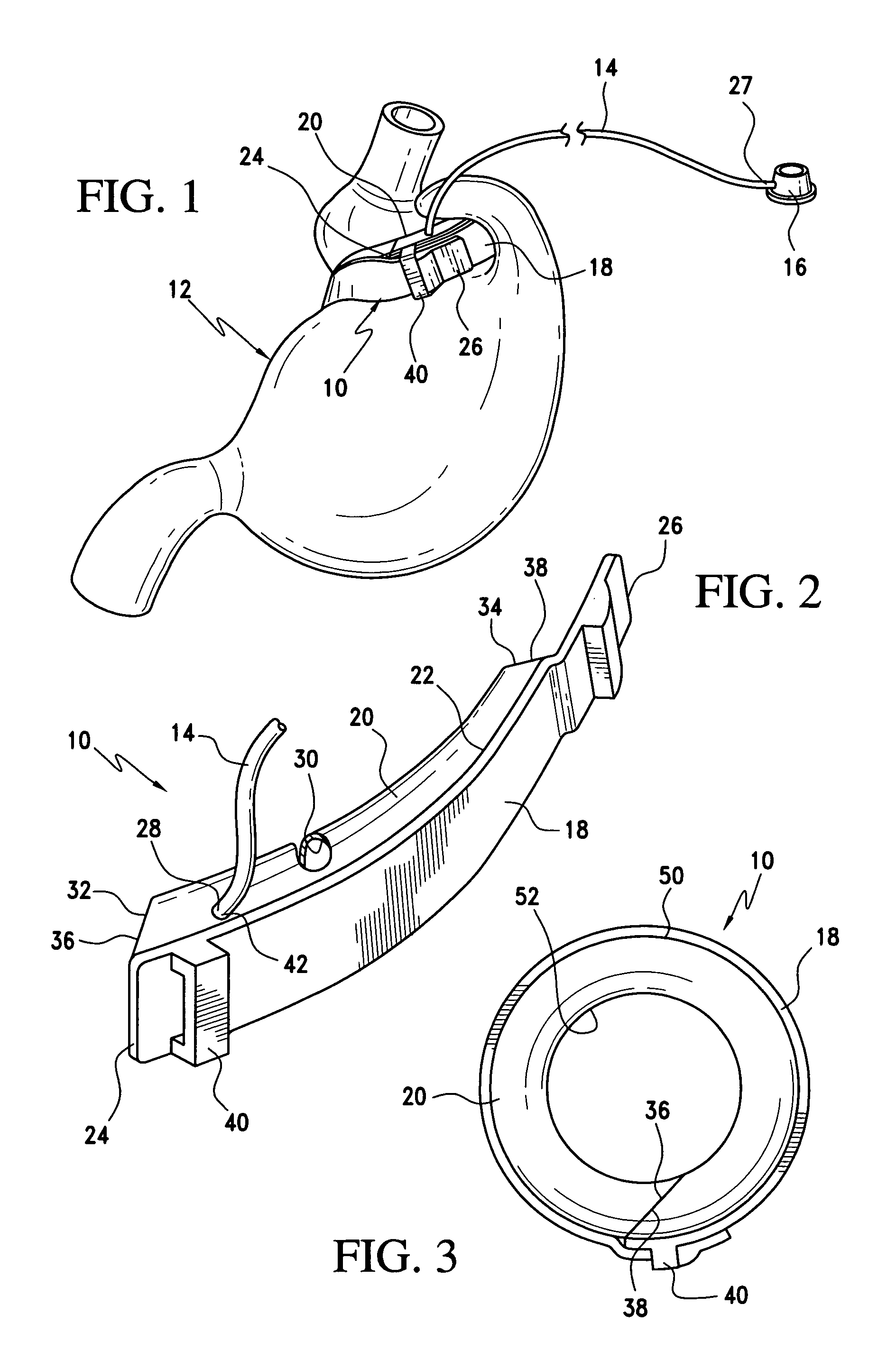 Gastric band with mating end profiles