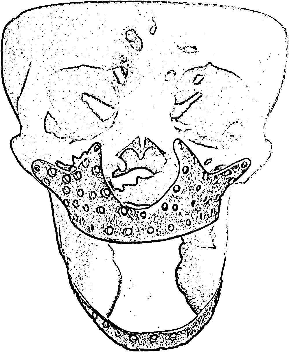 Maxillary bone repair stent and manufacturing method thereof