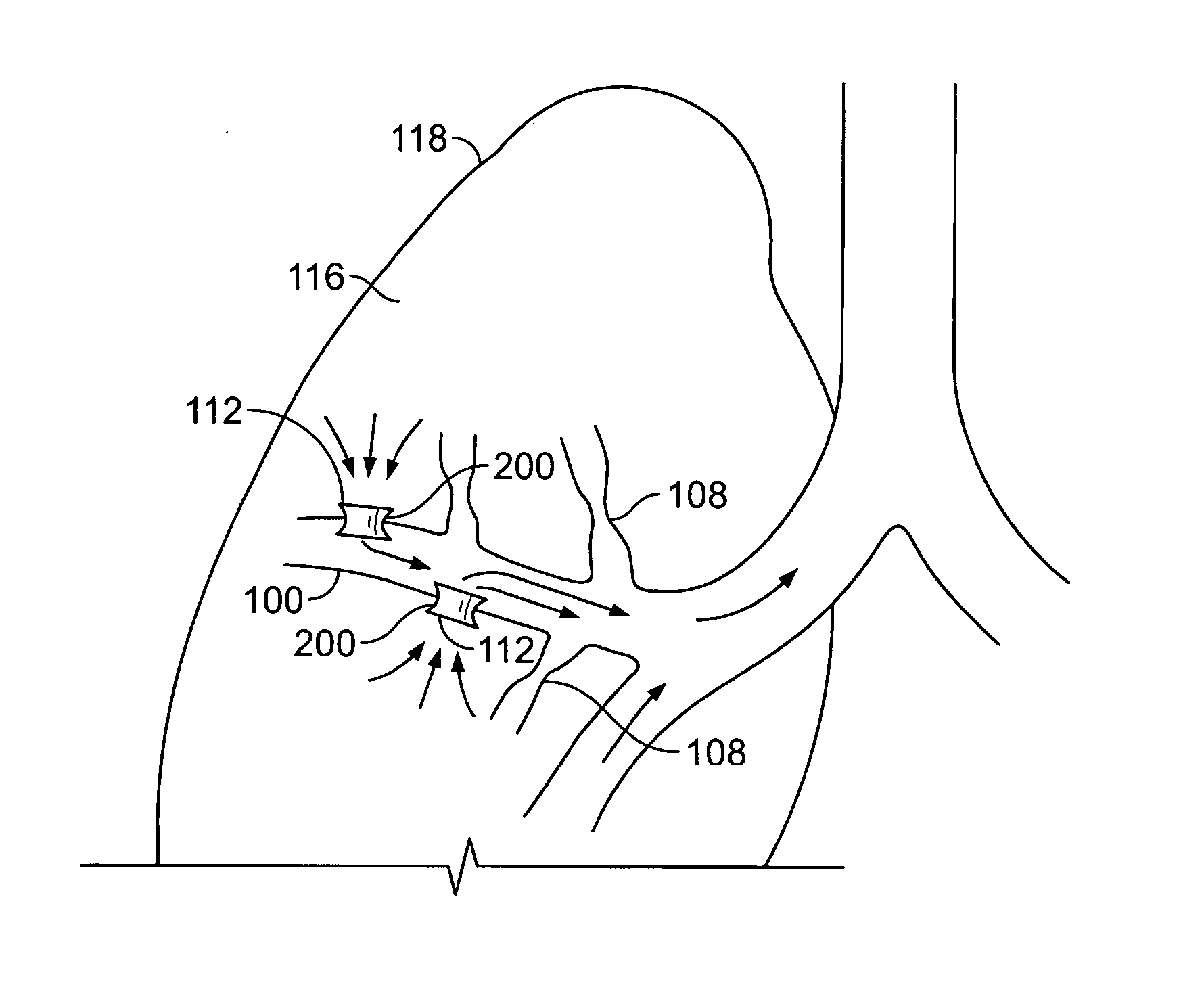 Methods and devices for maintaining patency of surgically created channels in a body organ