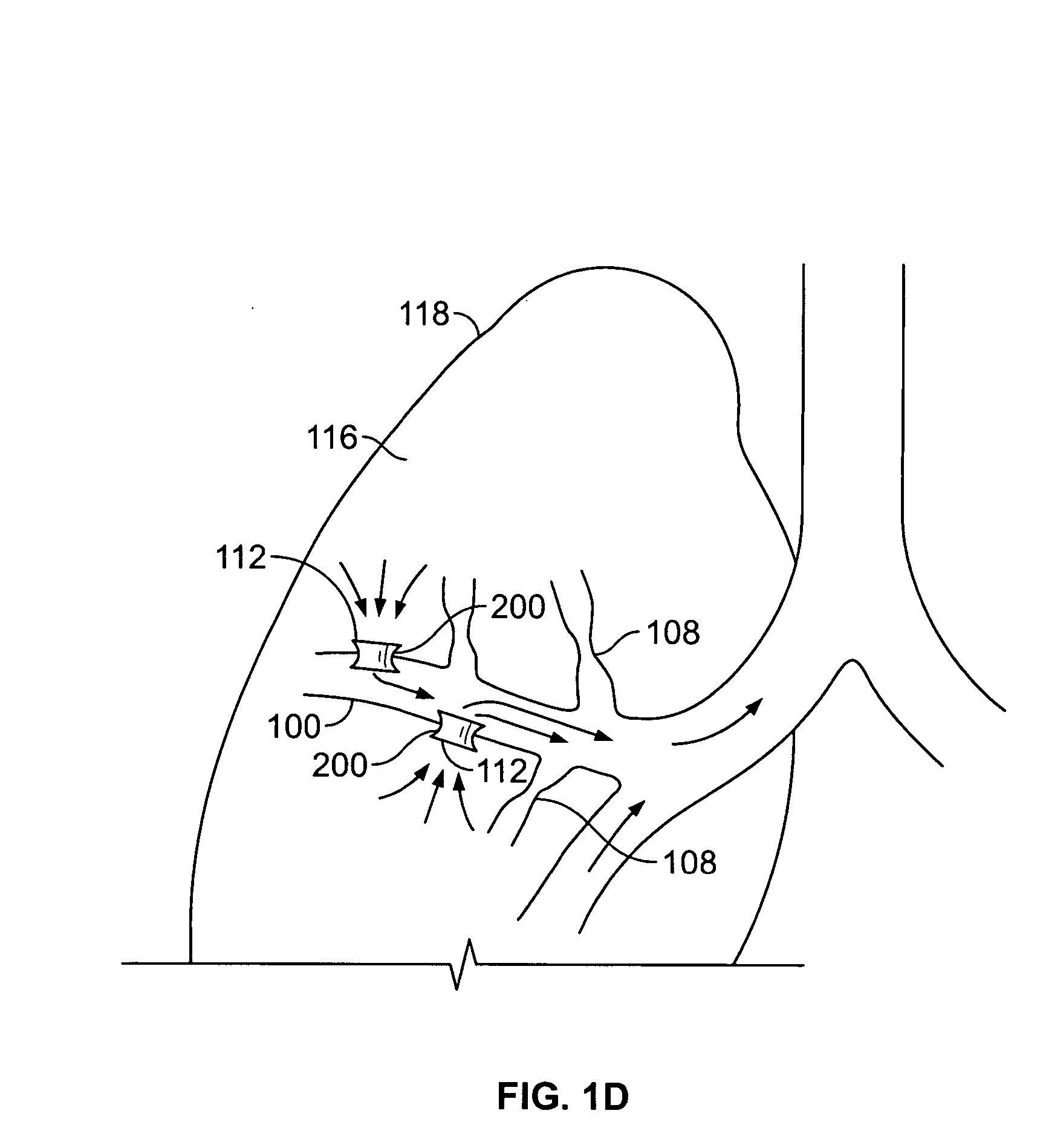 Methods and devices for maintaining patency of surgically created channels in a body organ