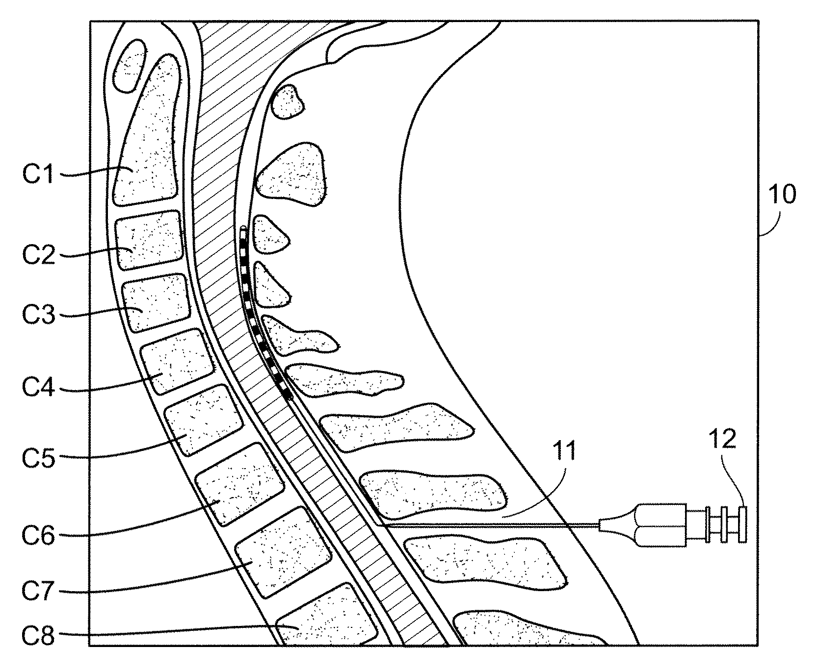 Cervical spinal cord stimulation for the treatment and prevention of cerebral vasospasm