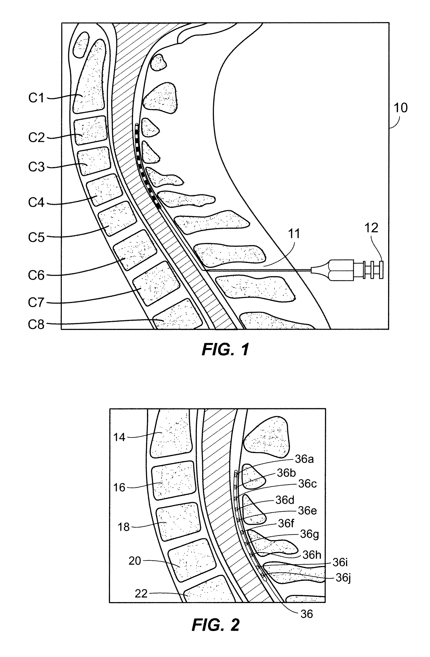 Cervical spinal cord stimulation for the treatment and prevention of cerebral vasospasm