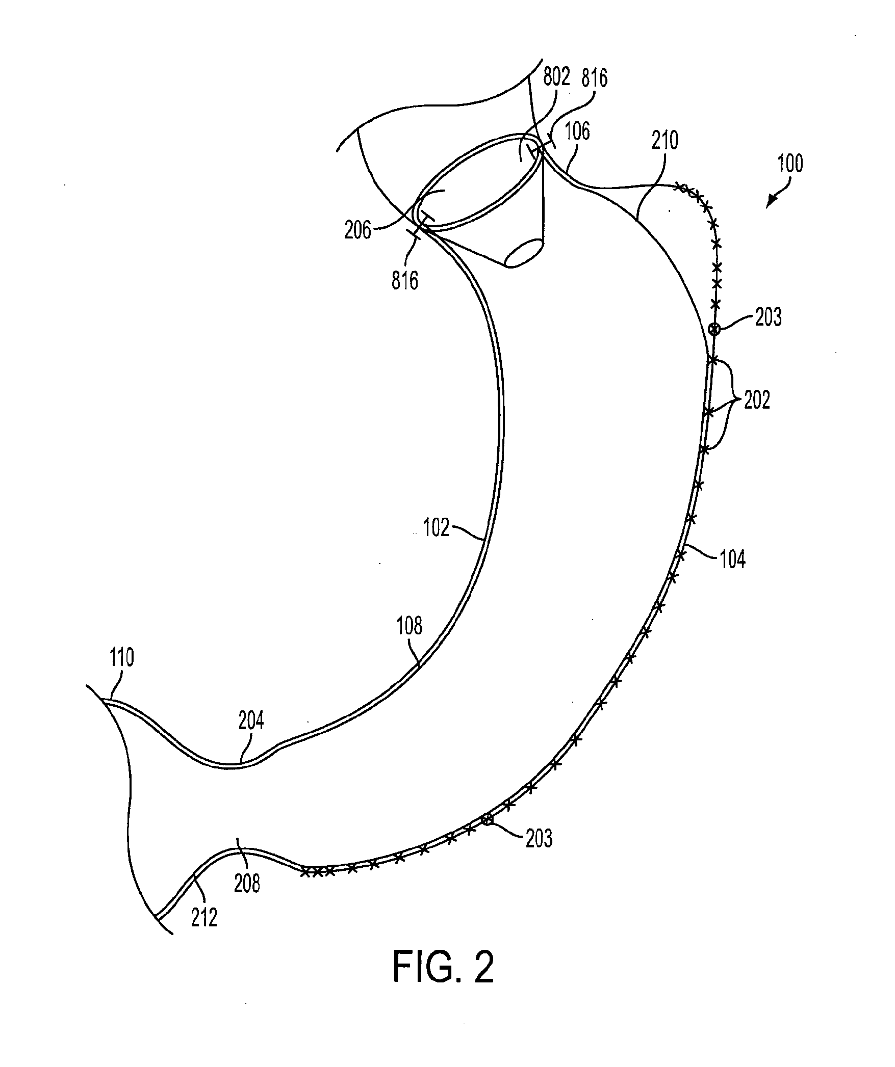 Method and apparatus for treating obesity and controlling weight gain and absorption of glucose in mammals