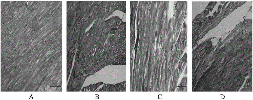 Application of sinomenine in preparation of medicament for preventing and treating myocardial hypertrophy