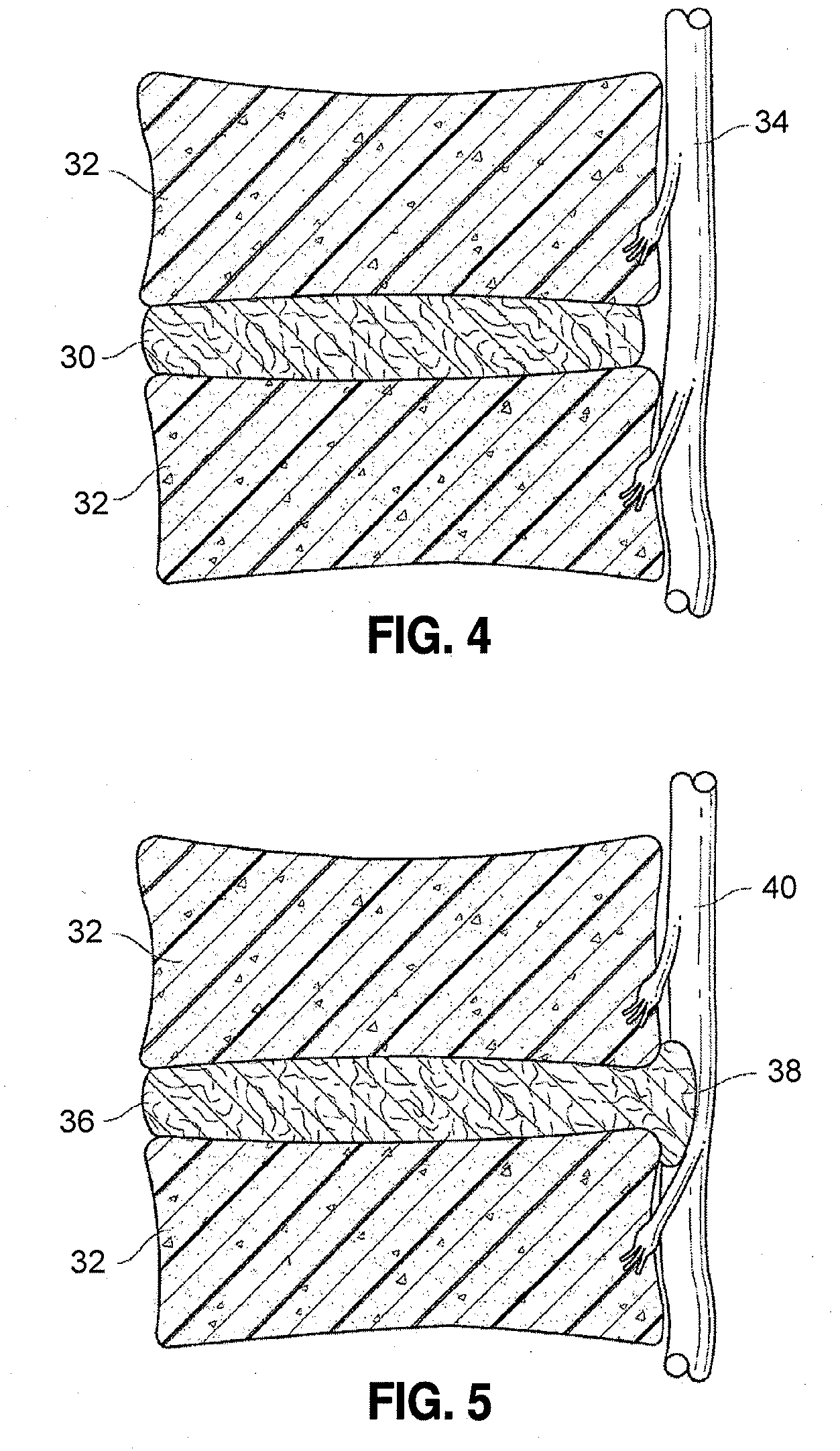 Spinal implants and methods